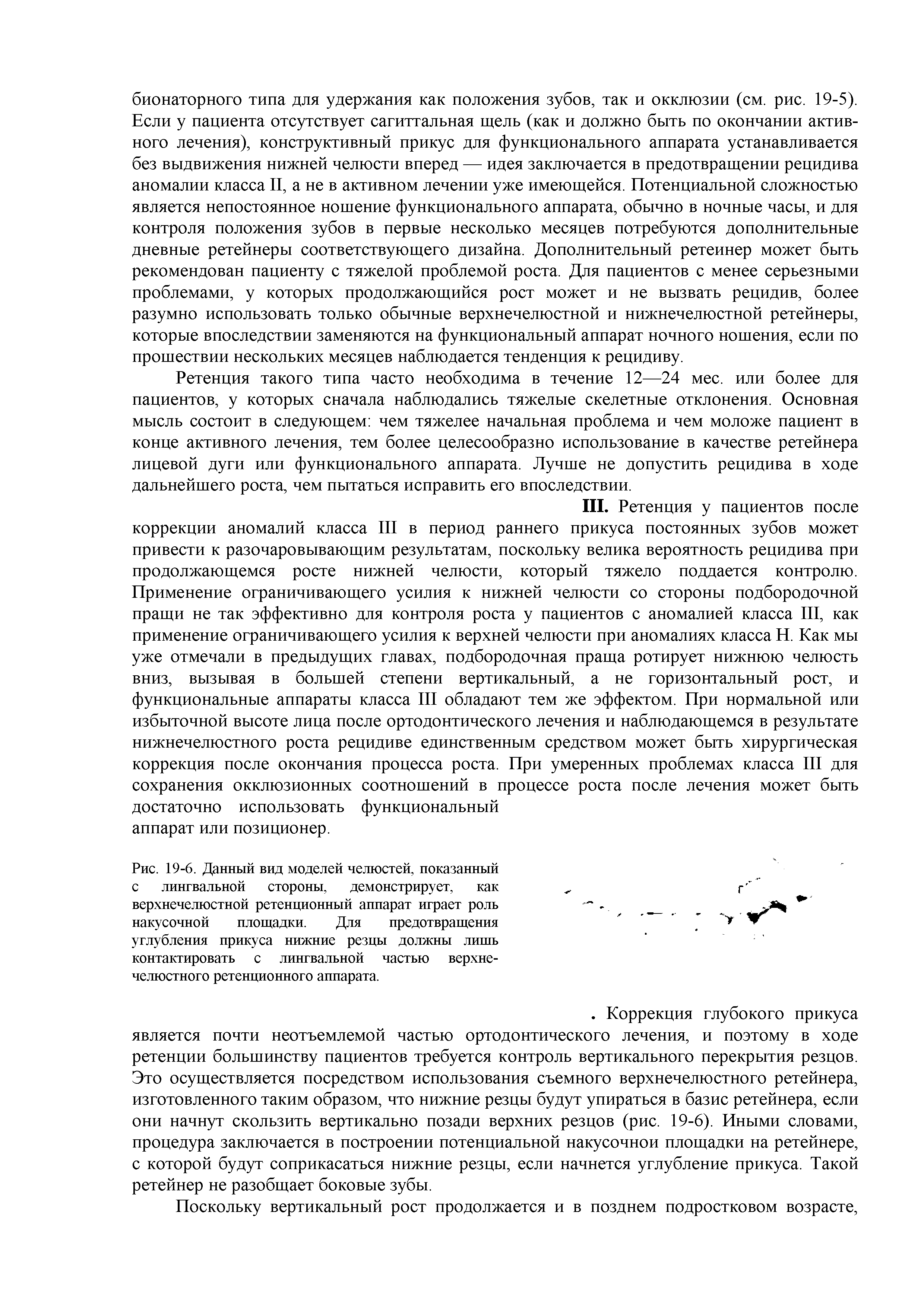 Рис. 19-6. Данный вид моделей челюстей, показанный с лингвальной стороны, демонстрирует, как верхнечелюстной ретенционный аппарат играет роль накусочной площадки. Для предотвращения углубления прикуса нижние резцы должны лишь контактировать с лингвальной частью верхнечелюстного ретенционного аппарата.