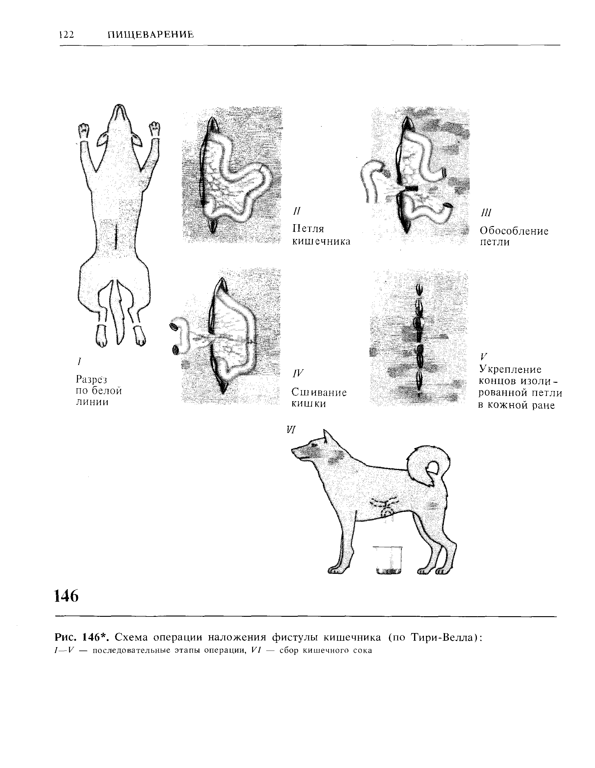 Рис. 146. Схема операции наложения фистулы кишечника (по Тири-Велла) /—V — последовательные этапы операции, VI — сбор кишечного сока...