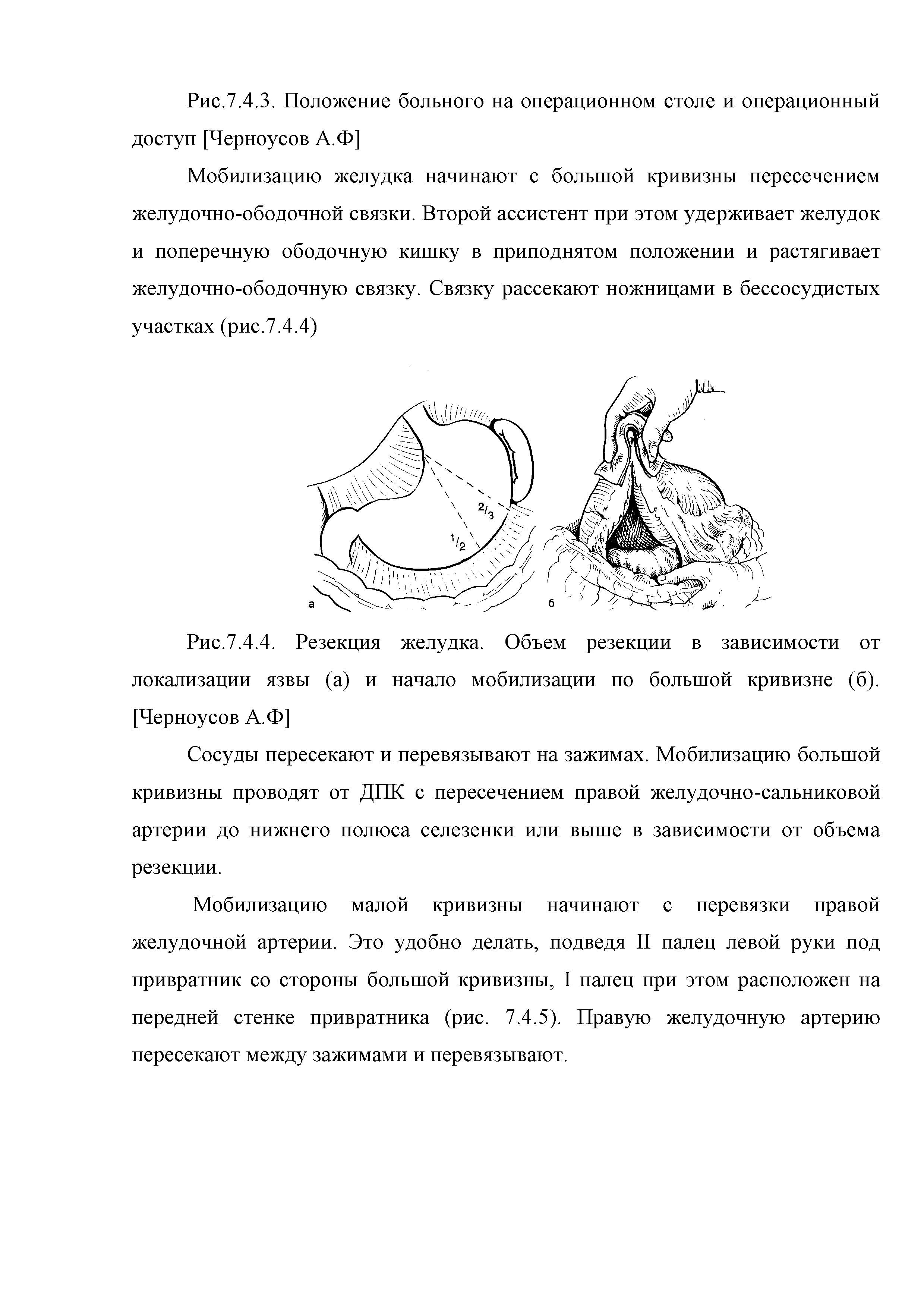 Рис. 7.4.4. Резекция желудка. Объем резекции в зависимости от локализации язвы (а) и начало мобилизации по большой кривизне (б). [Черноусов А.Ф]...