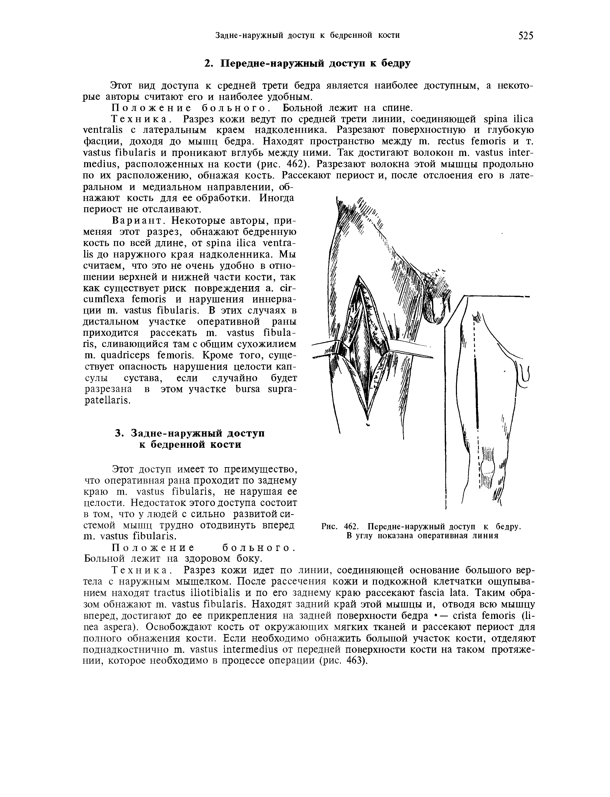 Рис. 462. Передне-наружный доступ к бедру. В углу показана оперативная линия...