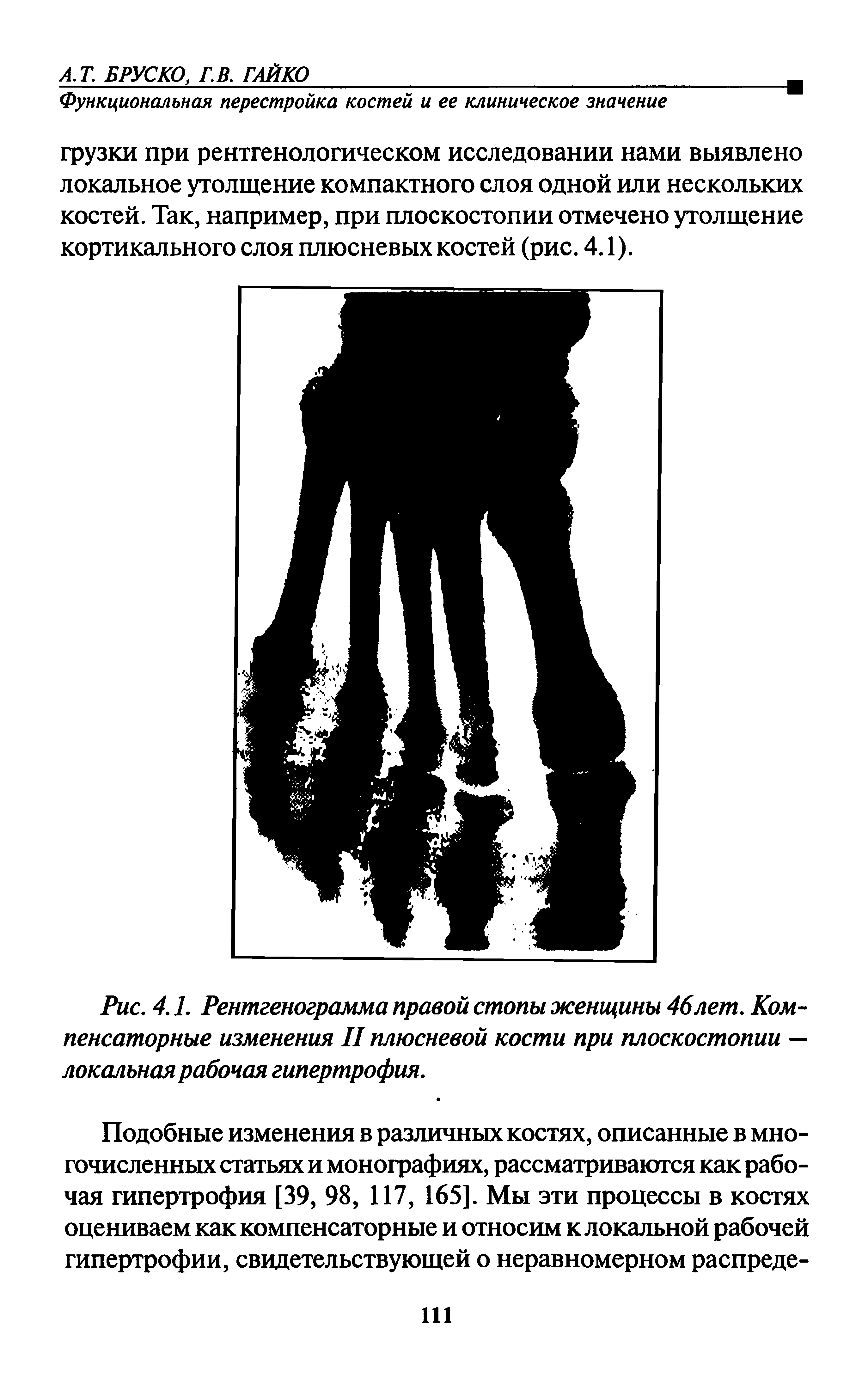 Рис. 4.1. Рентгенограмма правой стопы женщины 46лет. Компенсаторные изменения II плюсневой кости при плоскостопии — локальная рабочая гипертрофия.
