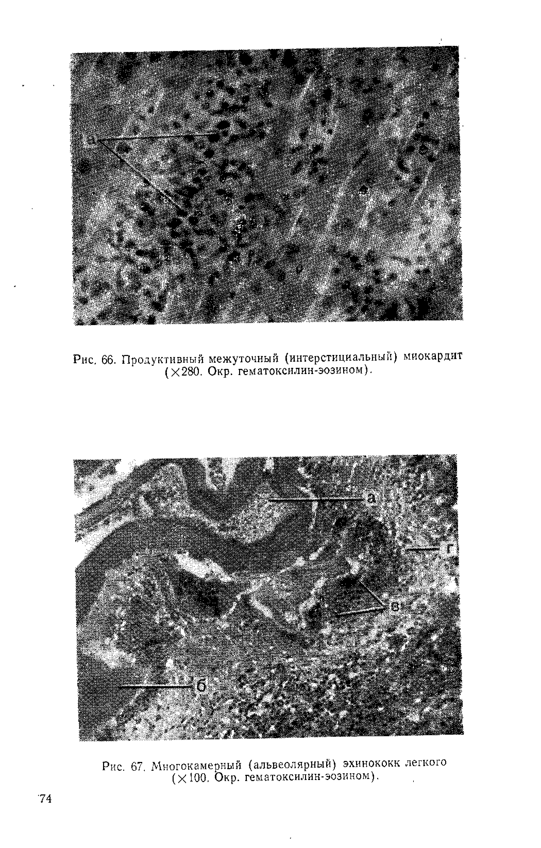 Рис. 67. Многокамерный (альвеолярный) эхинококк легкого (ХЮО. Окр. гематоксилин-эозином).