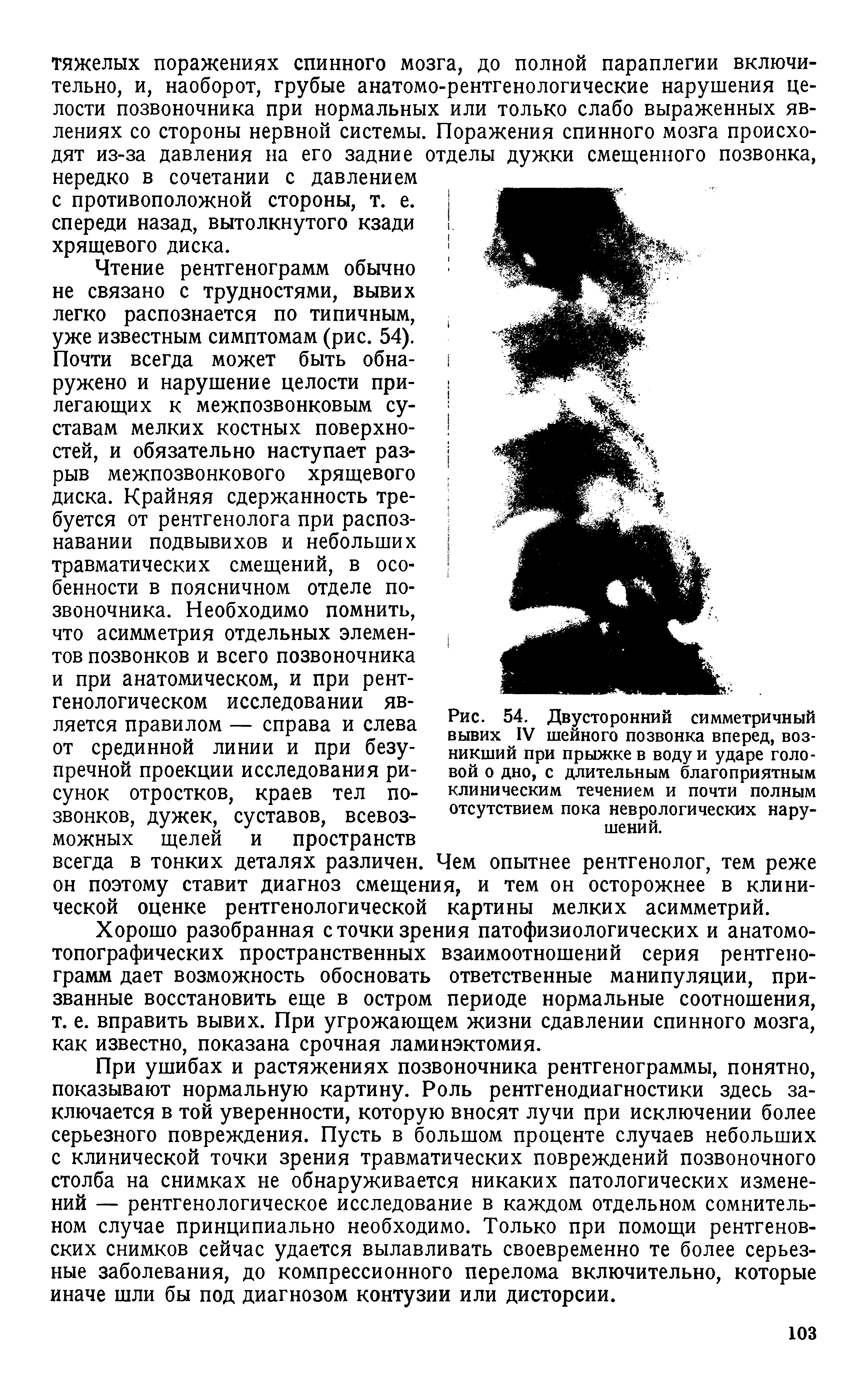 Рис. 54. Двусторонний симметричный вывих IV шейного позвонка вперед, возникший при прыжке в воду и ударе головой о дно, с длительным благоприятным клиническим течением и почти полным отсутствием пока неврологических нарушений.