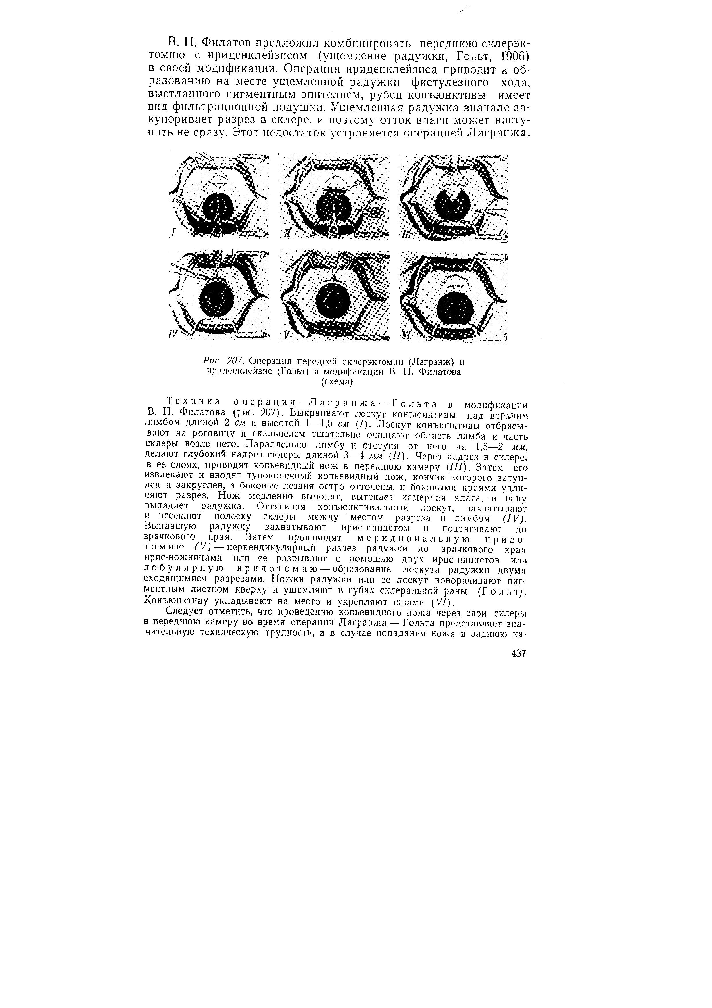 Рис. 207. Операция передней склерэктомип (Лагранж) и ириденклейзис (Гольт) в модификации В.. П. Филатова...