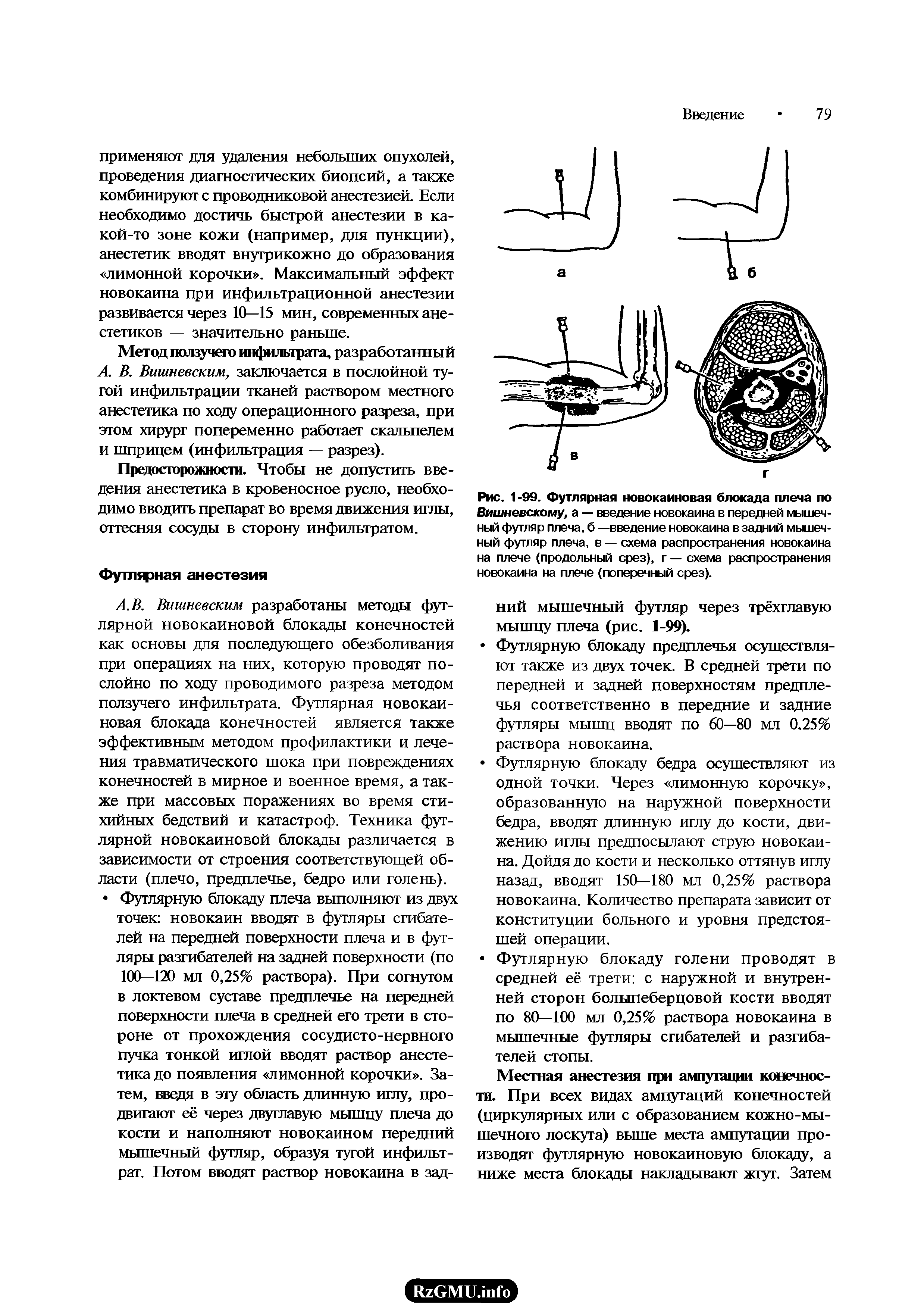 Рис. 1-99. Футлярная новокаиновая блокада плеча по Вишневскому, а — введение новокаина в передней мышечный футляр плеча, б —введение новокаина в задний мышечный футляр плеча, в — схема распространения новокаина на плече (продольный срез), г — схема распространения новокаина на плече (поперечный срез).