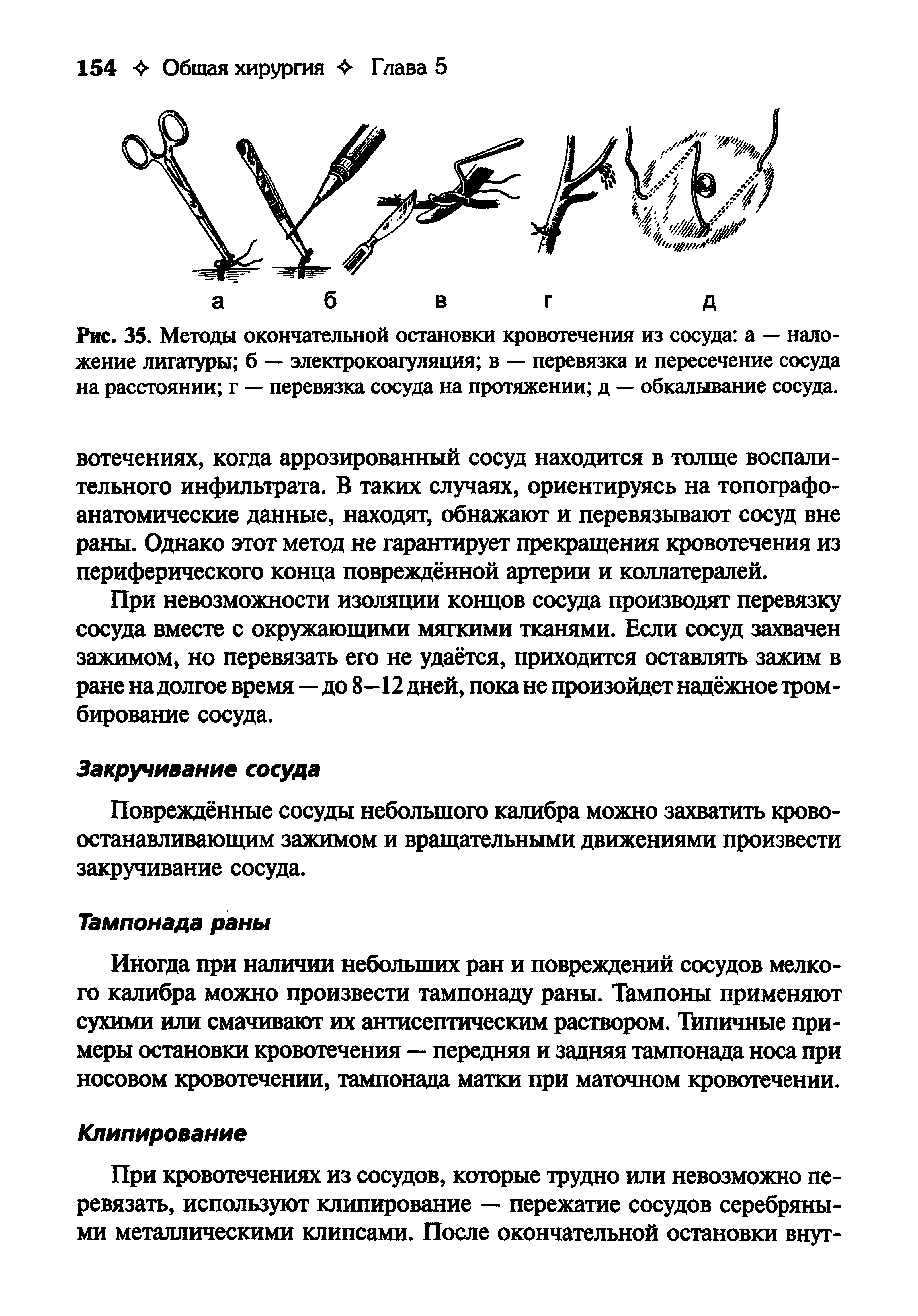 Рис. 35. Методы окончательной остановки кровотечения из сосуда а — наложение лигатуры б — электрокоагуляция в — перевязка и пересечение сосуда на расстоянии г — перевязка сосуда на протяжении д — обкалывание сосуда.