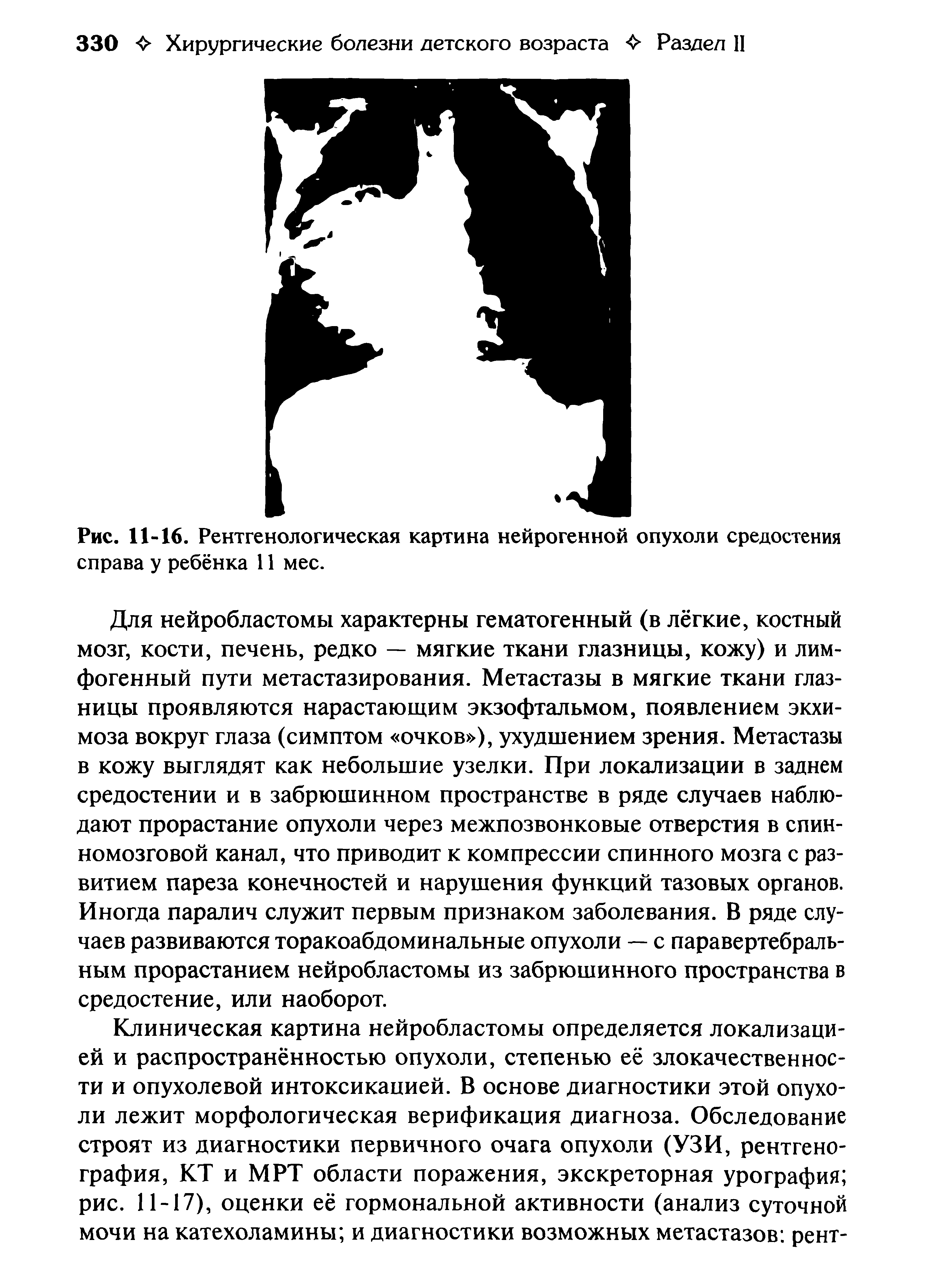 Рис. 11-16. Рентгенологическая картина нейрогенной опухоли средостения справа у ребёнка 11 мес.