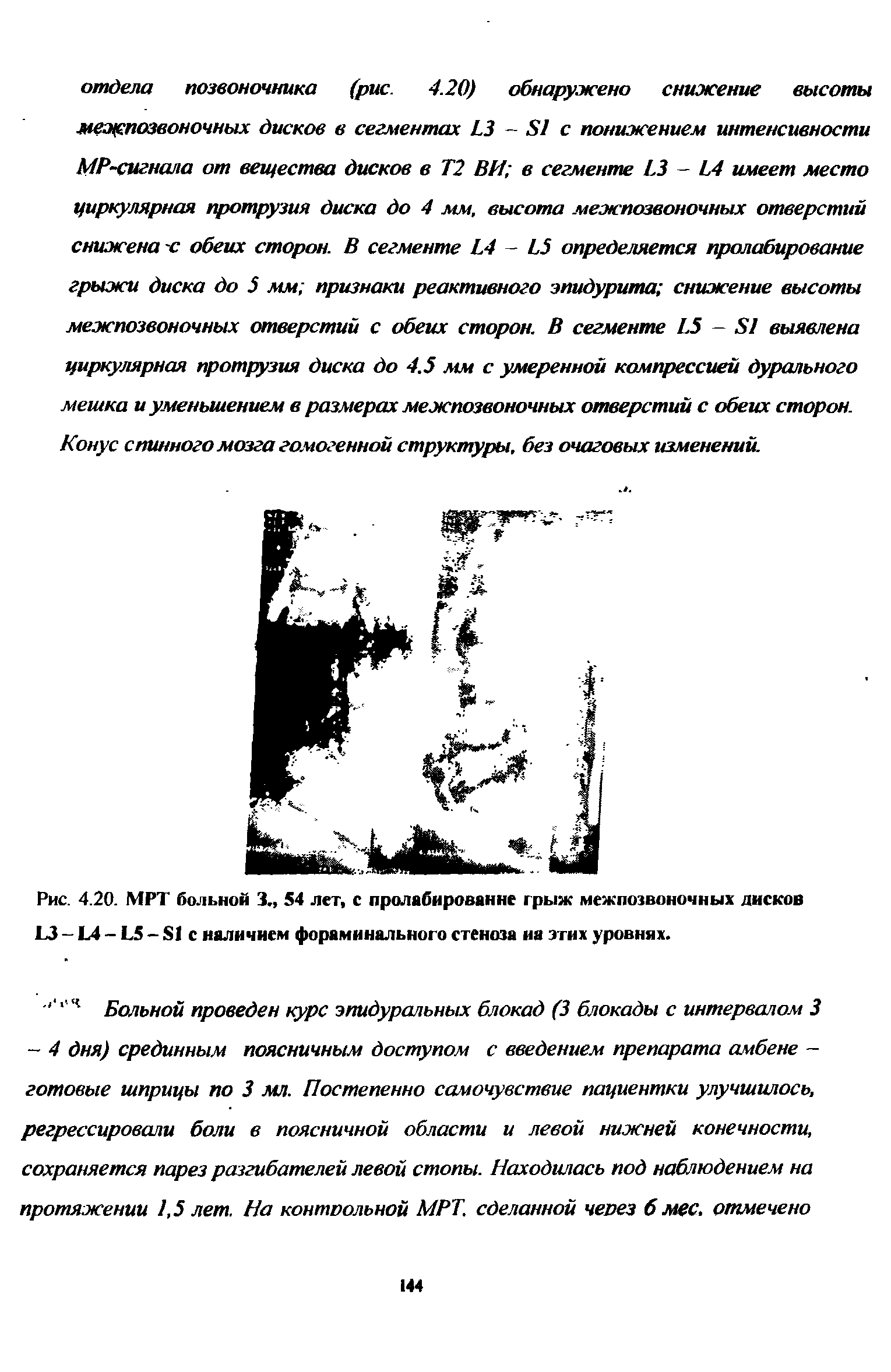 Рис. 4.20. МРТ больной 3., 54 лет, с пролабирование грыж межпозвоночных дисков I3 L4 - L5 - S1 с наличием фораминального стеноза иа этих уровнях.