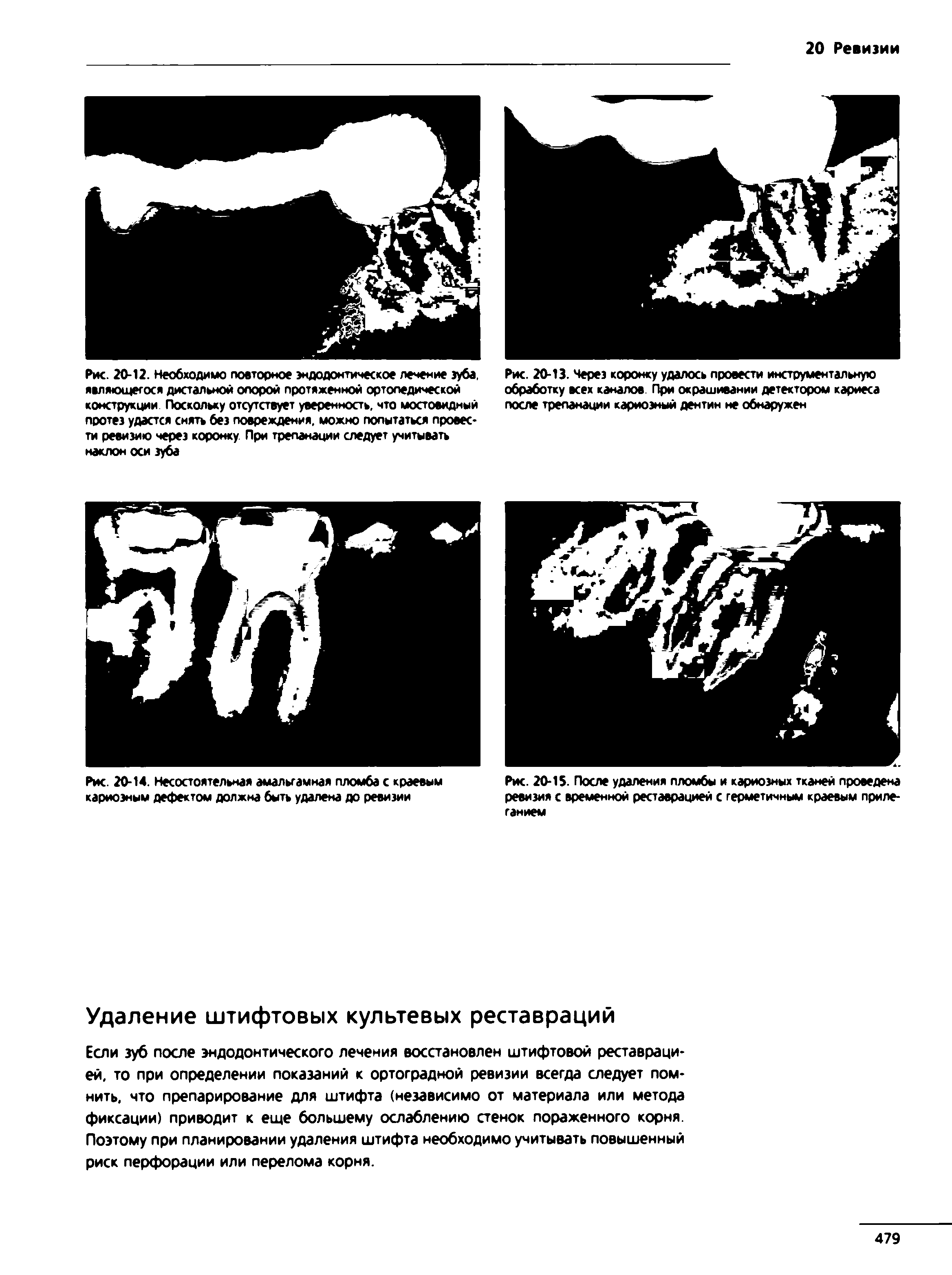 Рис. 20-13. Через коронку удалось провести инструментальную обработку всех каналов. При окрашивании детектором кариеса после трепанации кариозный дентин не обнаружен...