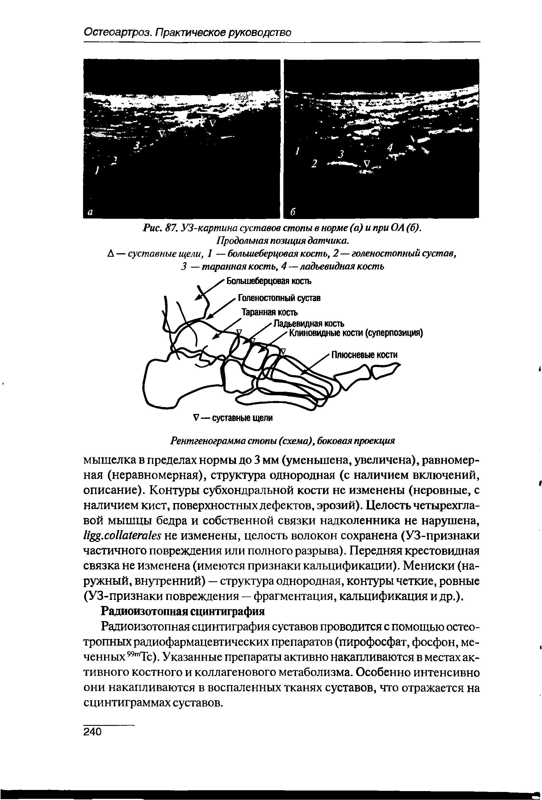 Рис. 87. УЗ-картина суставов стопы в норме (а) и при ОА (б). Продольная позиция датчика.