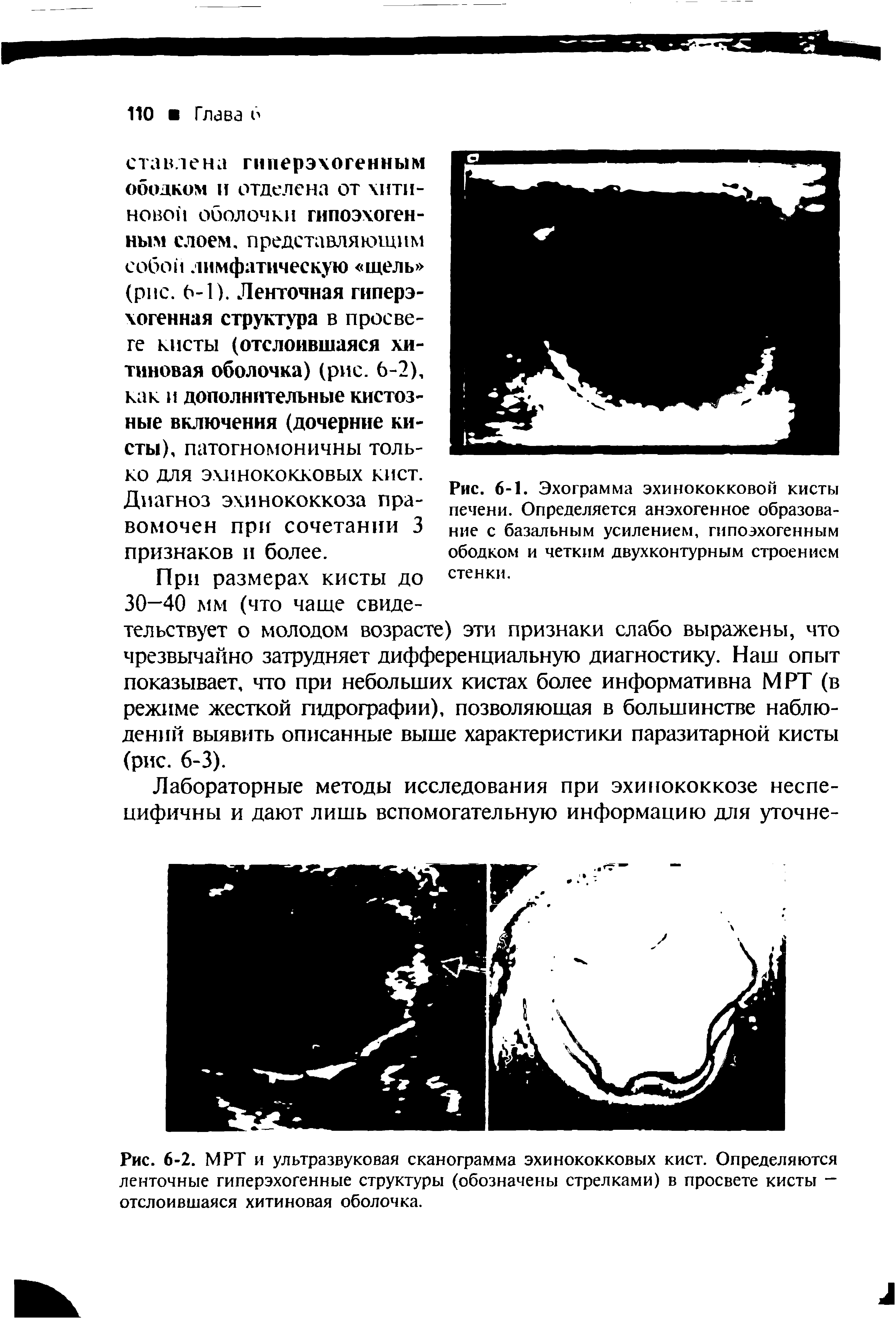 Рис. 6-1. Эхограмма эхинококковой кисты печени. Определяется анэхогенное образование с базальным усилением, гипоэхогенным ободком и четким двухконтурным строением стенки.