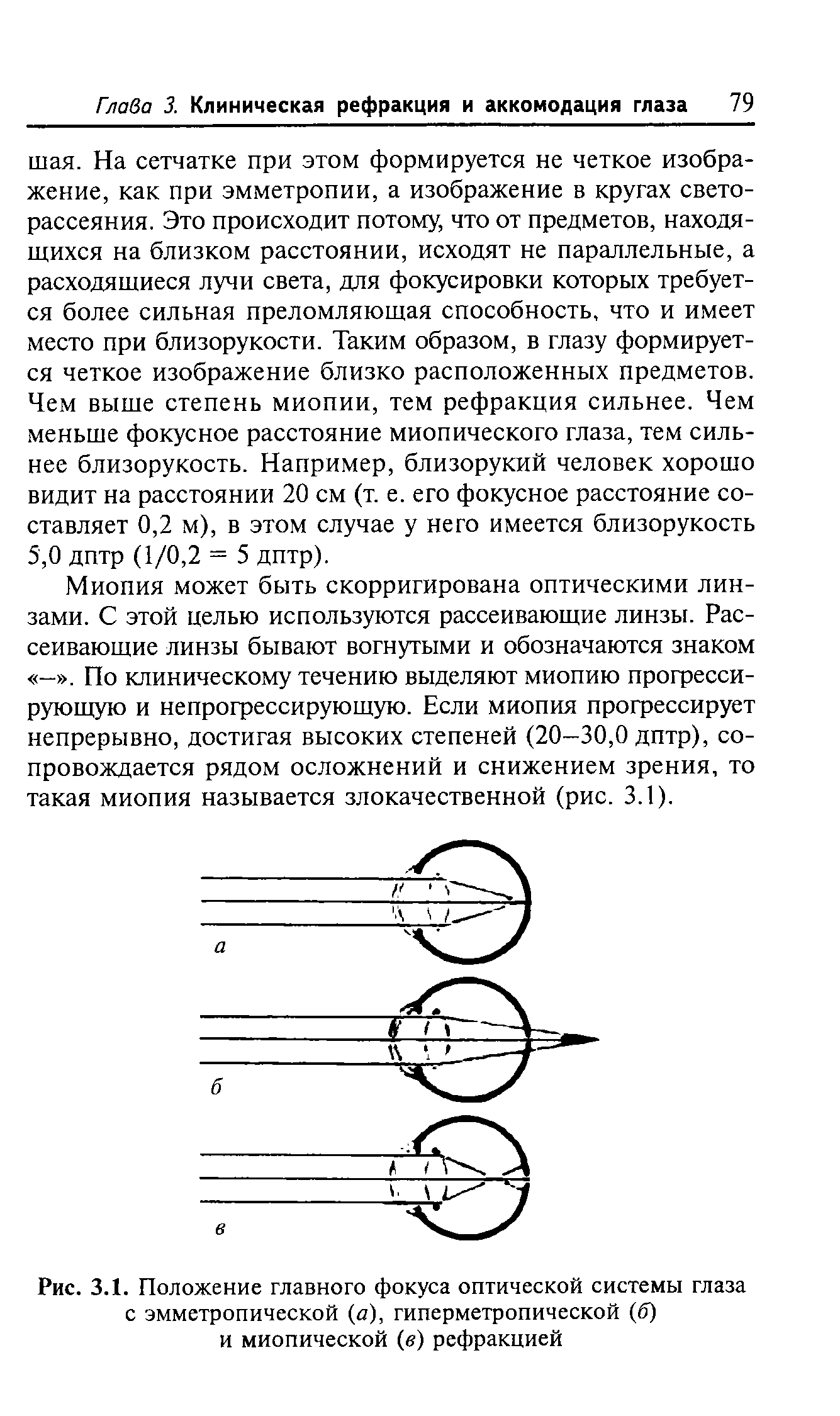 Рис. 3.1. Положение главного фокуса оптической системы глаза с эмметропической а), гиперметропической (б) и миопической (в) рефракцией...