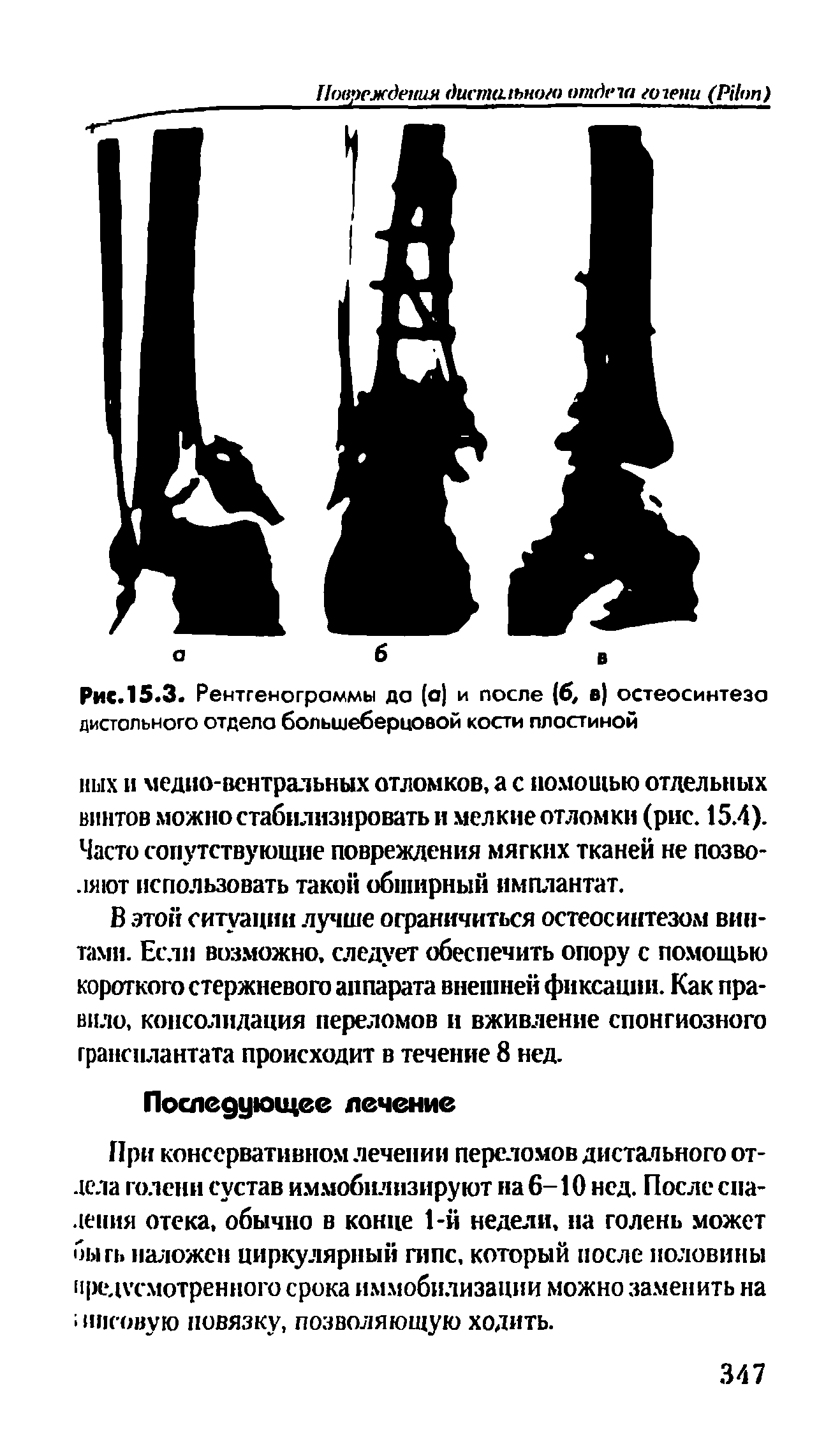 Рис. 15.3. Рентгеногроммы да (а) и после (б, в) остеосинтеза дистального отдела большеберцовой кости пластиной...