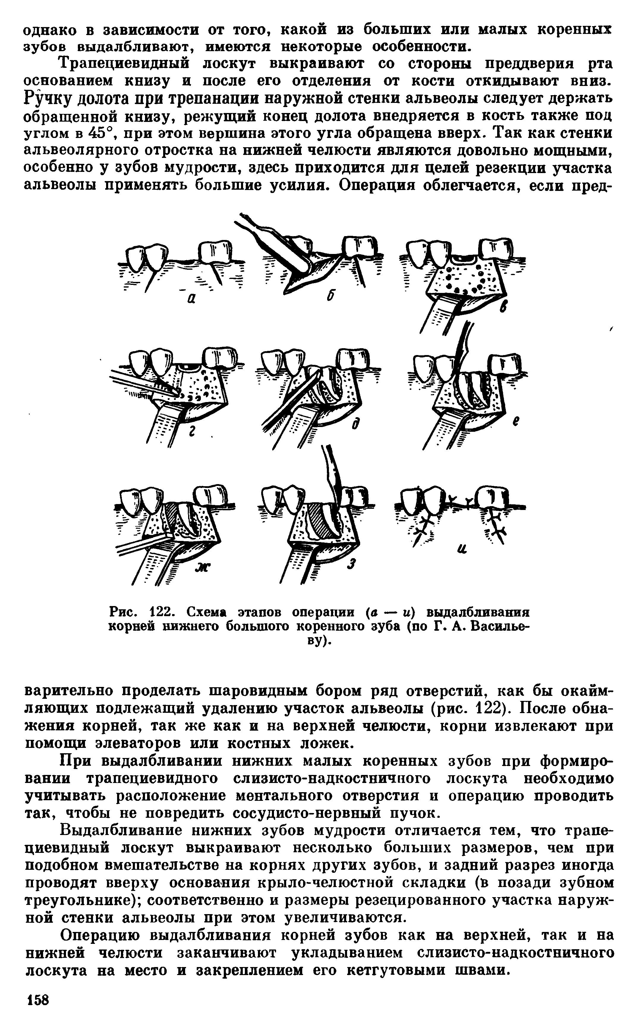 Рис. 122. Схема этапов операции (а — и) выдалбливания корней нижнего большого коренного зуба (по Г. А. Васильеву).