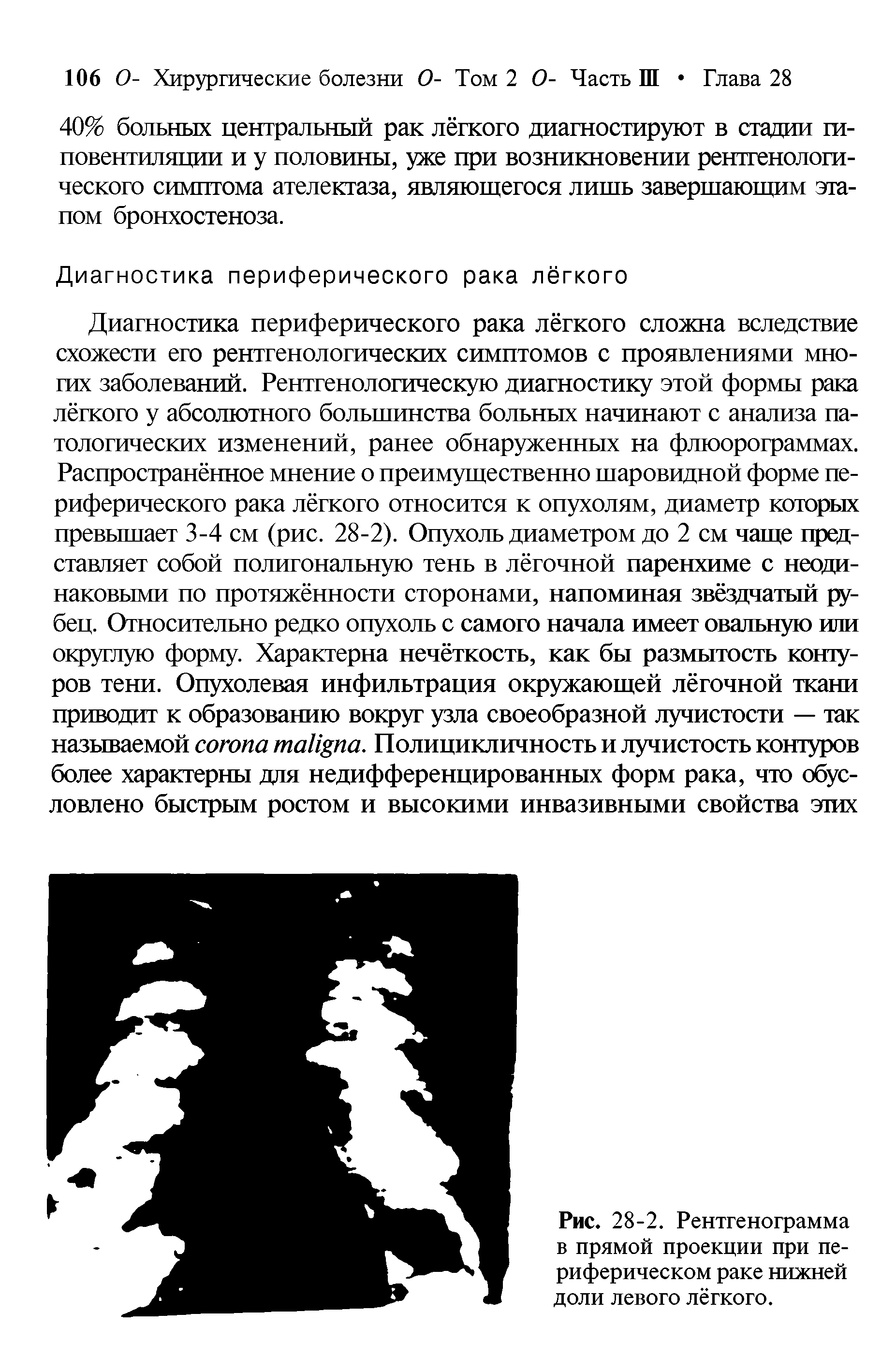 Рис. 28-2. Рентгенограмма в прямой проекции при периферическом раке нижней доли левого лёгкого.