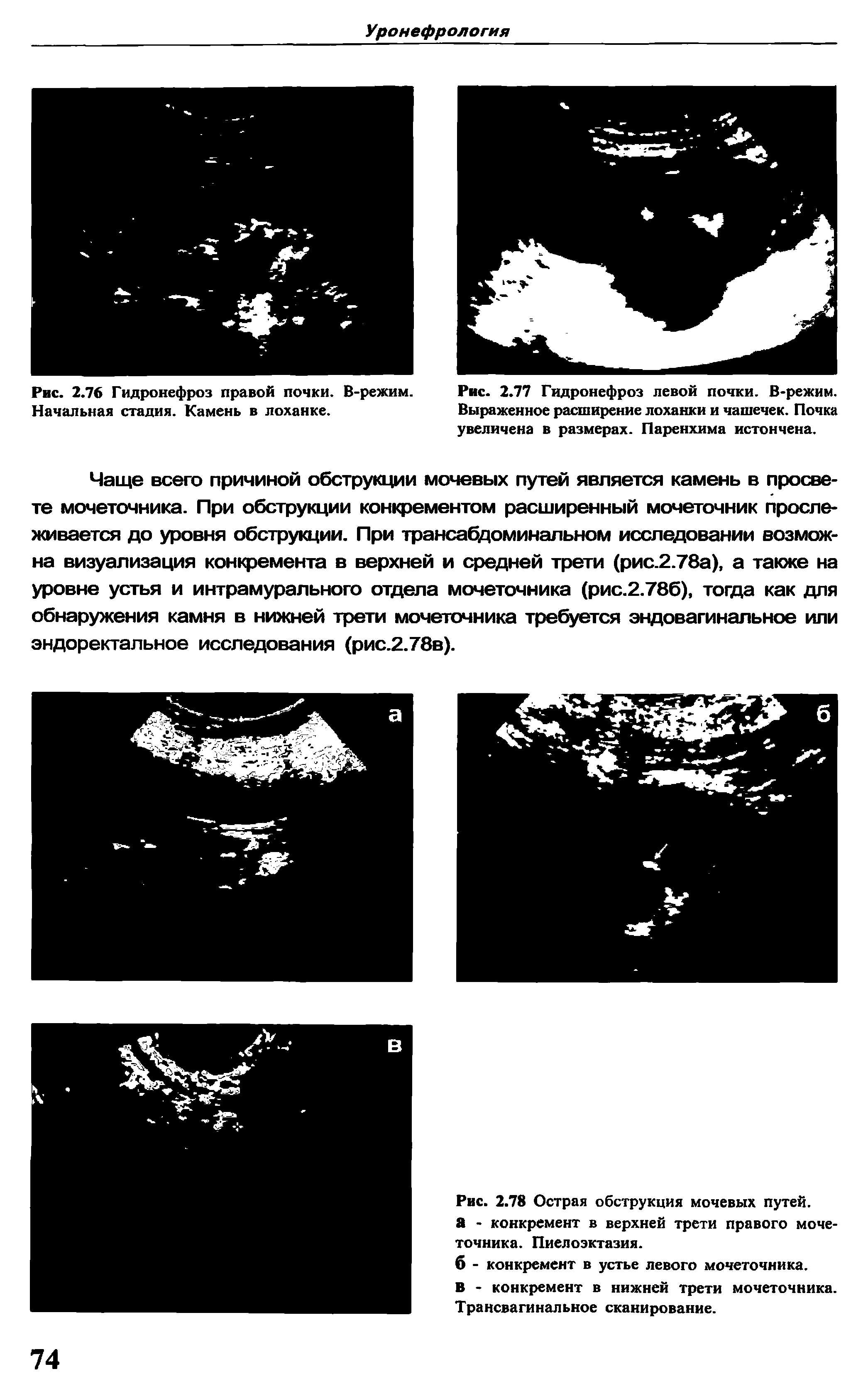 Рис. 2.78 Острая обструкция мочевых путей, а - конкремент в верхней трети правого мочеточника. Пиелоэктазия.