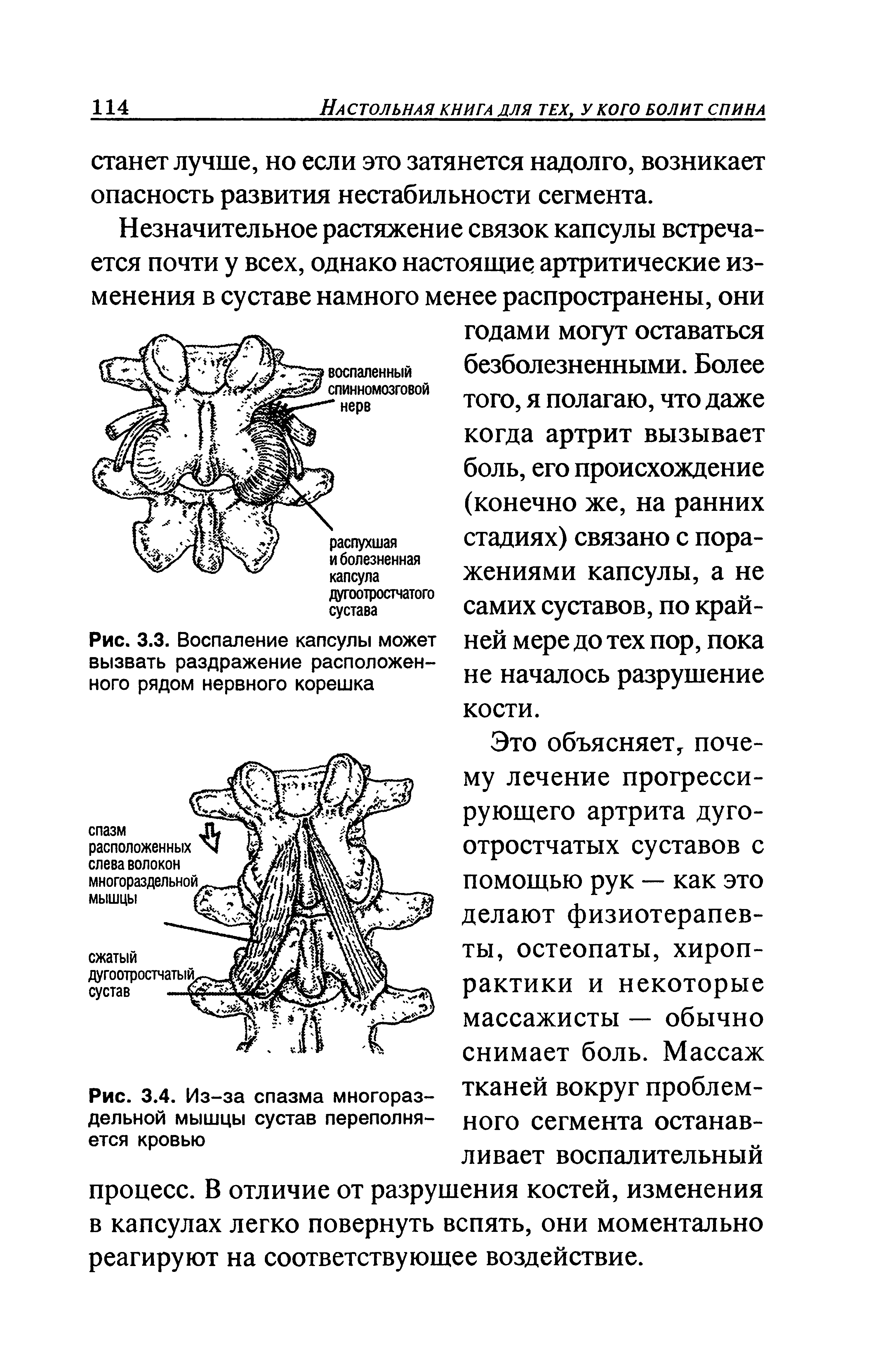 Рис. 3.4. Из-за спазма многораздельной мышцы сустав переполняется кровью...