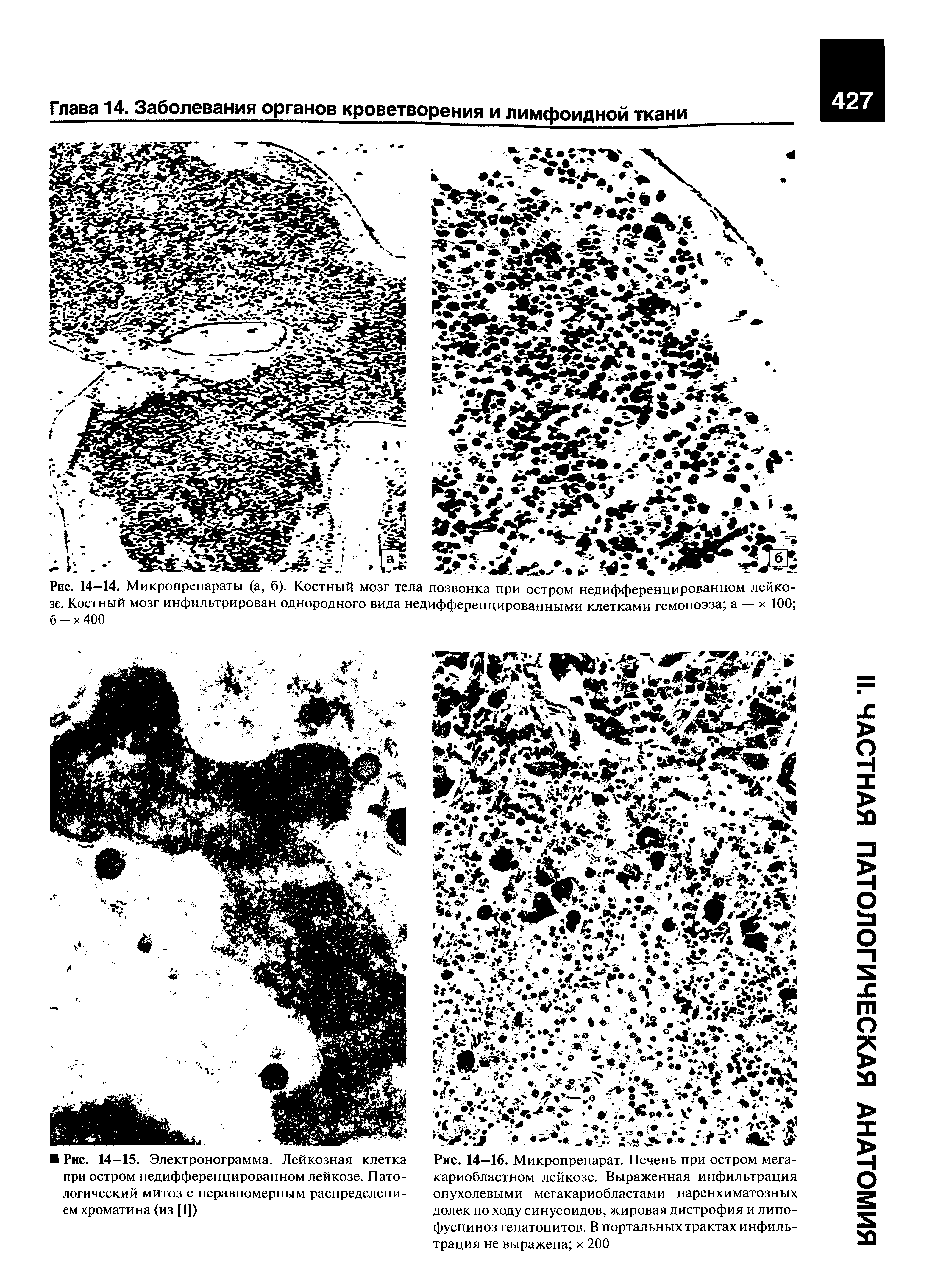 Рис. 14—16. Микропрепарат. Печень при остром мега-кариобластном лейкозе. Выраженная инфильтрация опухолевыми мегакариобластами паренхиматозных долек по ходу синусоидов, жировая дистрофия и липофусциноз гепатоцитов. В портальных трактах инфильтрация не выражена х 200...