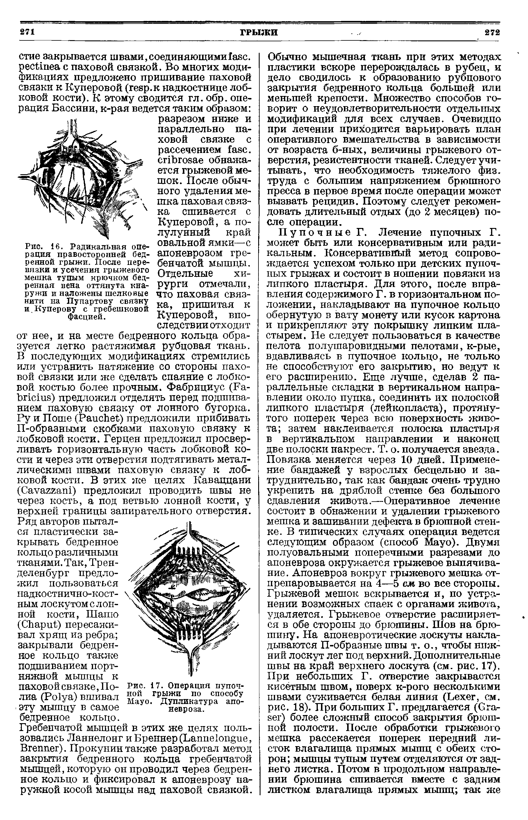 Рис. 17. Операция пупоч-ной грыжи по способу M . Дупликатура апоневроза.