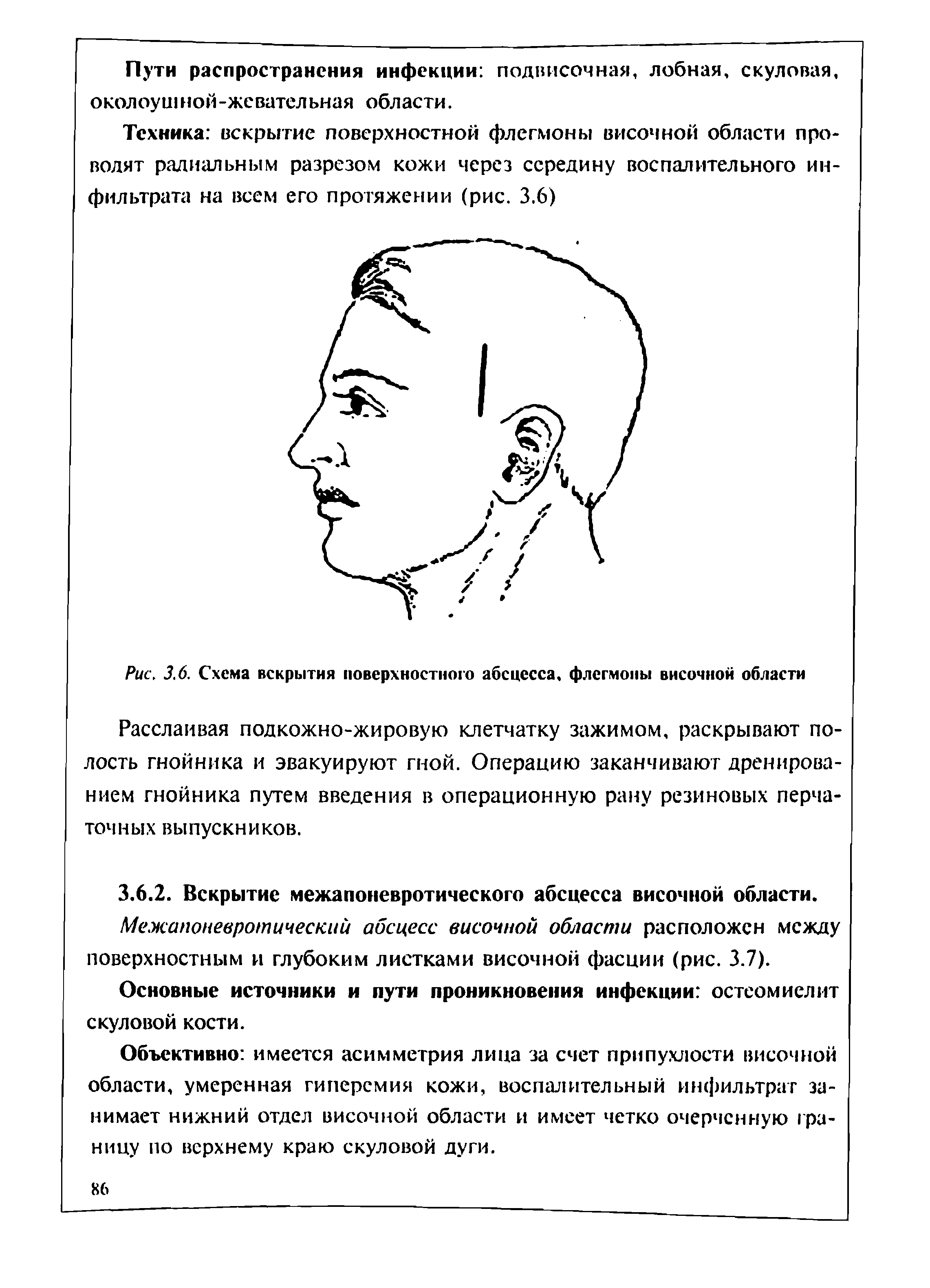 Рис. 3.6. Схема вскрытия поверхностного абсцесса, флегмоны височной области...