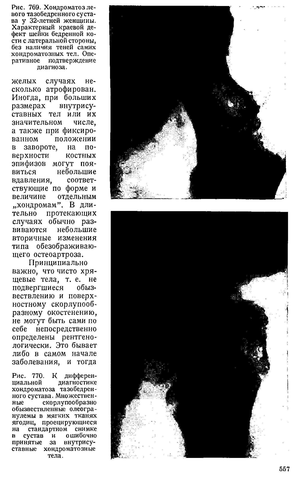 Рис. 770. К дифференциальной диагностике хондроматоза тазобедренного сустава. Множественные скорлупообразно обызвествленные олеогранулемы в мягких тканях ягодиц, проецирующиеся на стандартном снимке в сустав и ошибочно принятые за внутрисуставные хондроматозные тела.