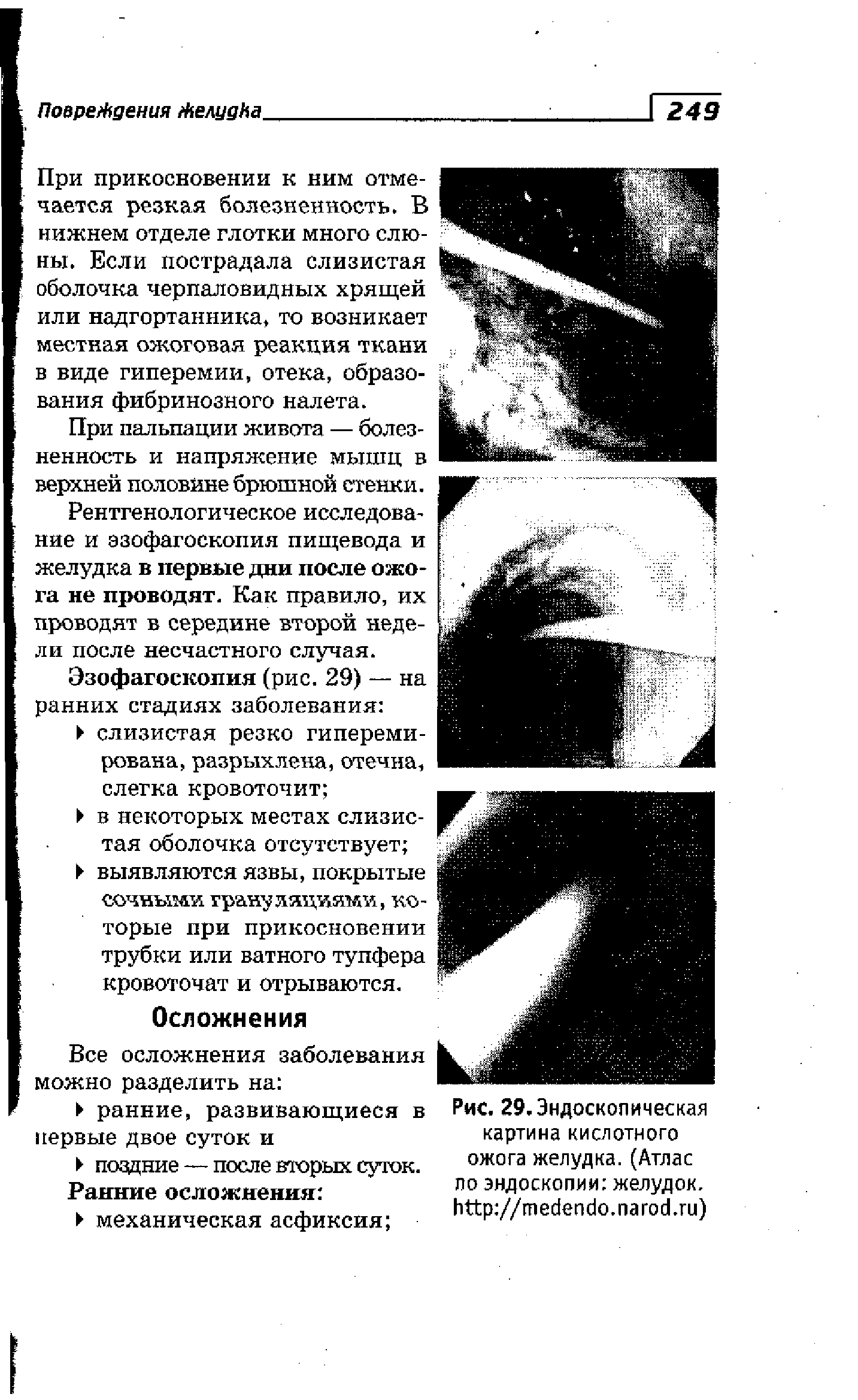 Рис. 29. Эндоскопическая картина кислотного ожога желудка. (Атлас по эндоскопии желудок. // . . )...