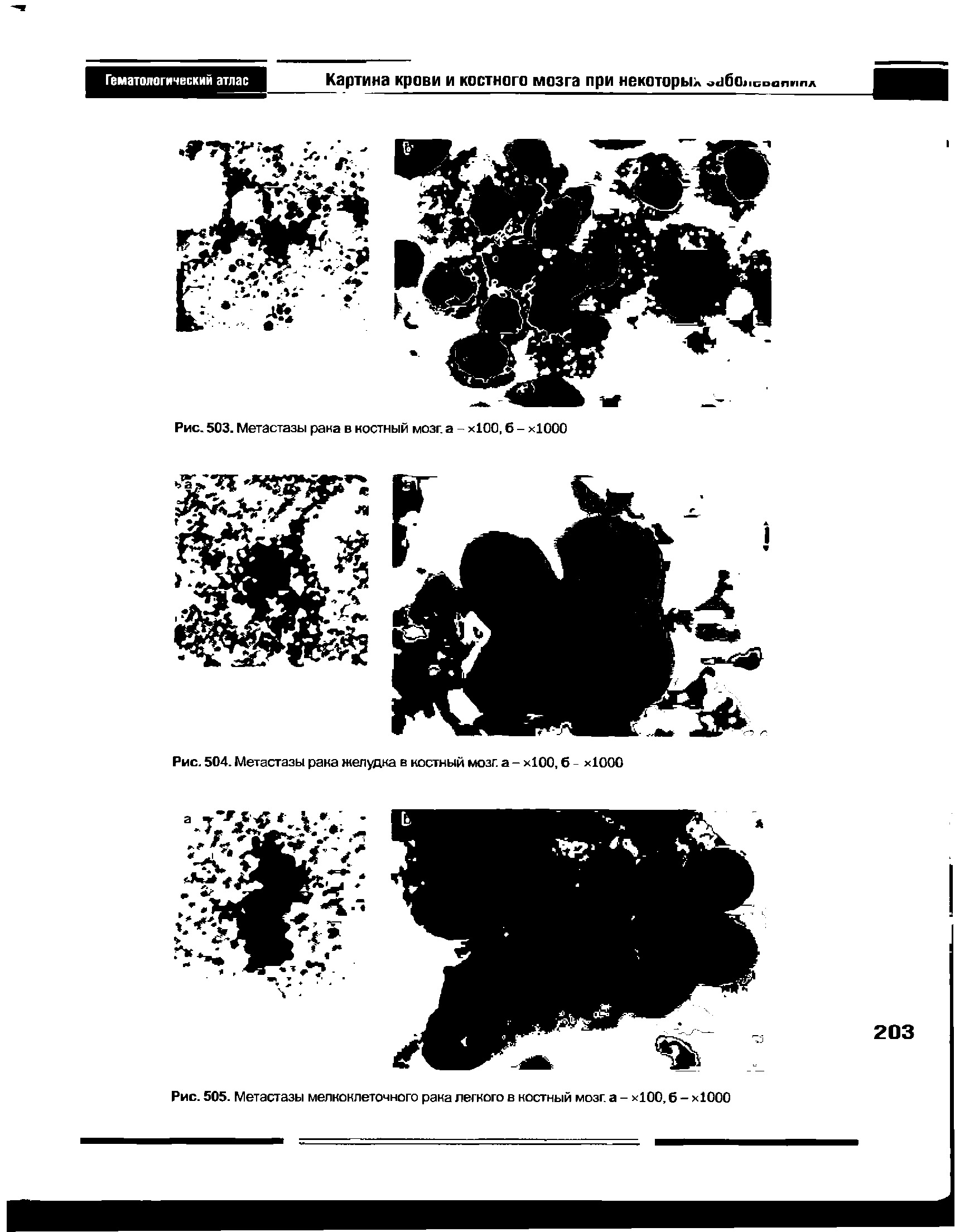 Рис. 504. Метастазы рака желудка в костный мозг, а - хЮО, 6 - хЮОО...