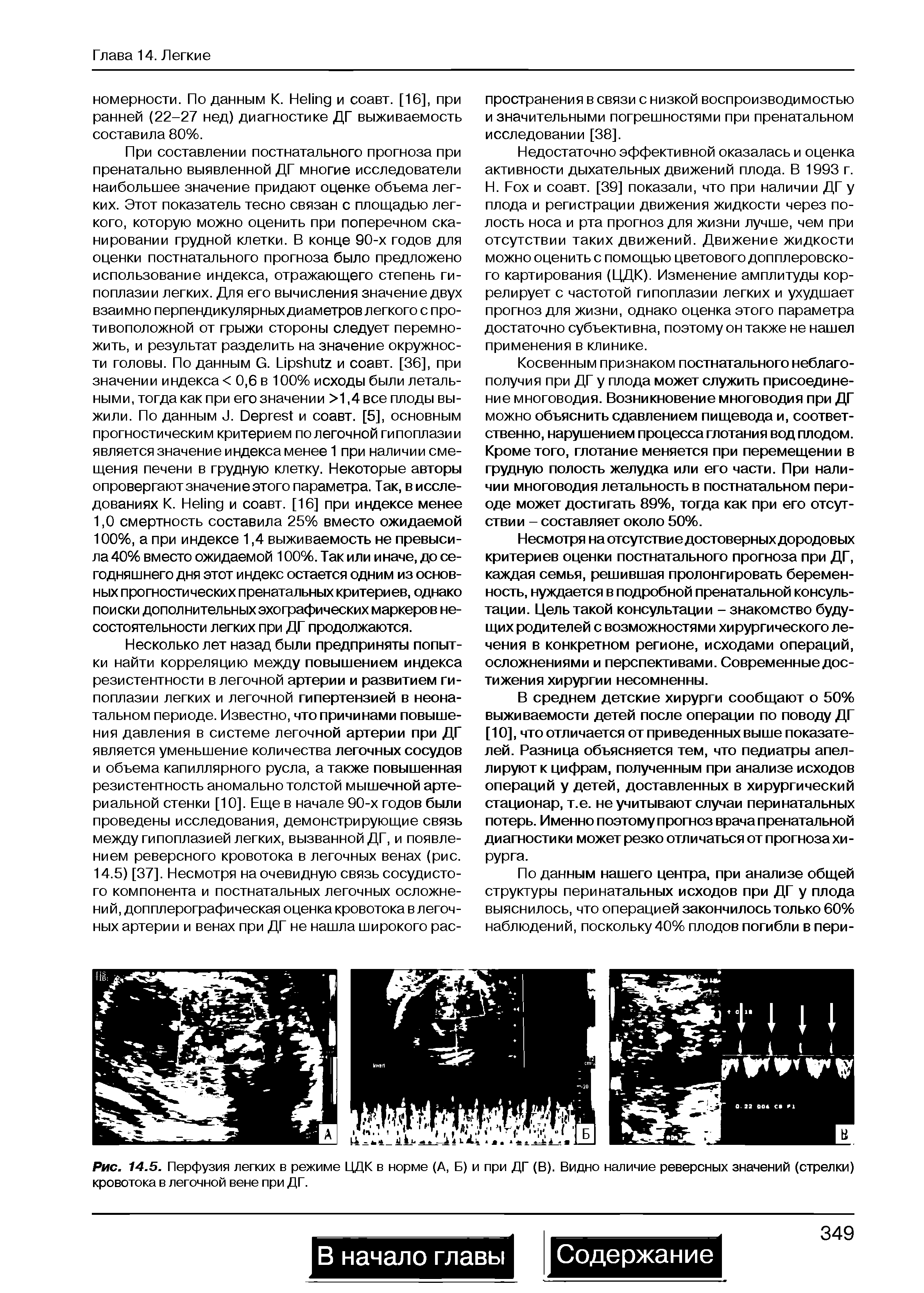 Рис. 14.5. Перфузия легких в режиме ЦДК в норме (А, Б) и при ДГ (В). Видно наличие реверсных значений (стрелки) кровотока в легочной вене при ДГ.