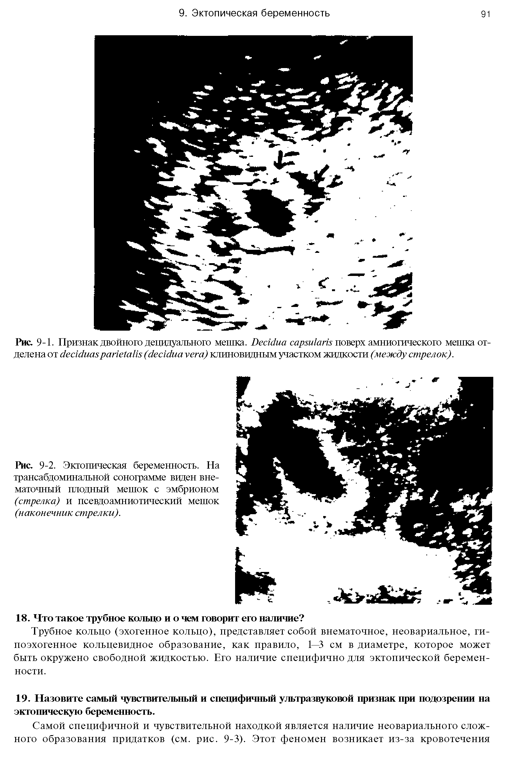 Рис. 9-1. Признак двойного децидуального мешка. D / / поверх амниотического мешка отделена от ( ) клиновидным участком жидкости (между стрелок).