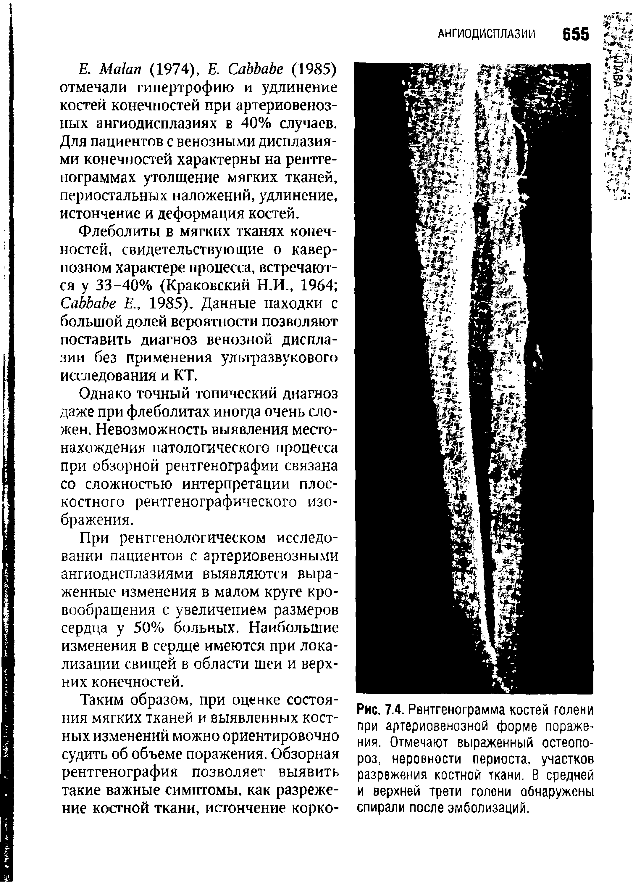 Рис. 74. Рентгенограмма костей голени при артериовенозной форме поражения. Отмечают выраженный остеопороз, неровности периоста, участков разрежения костной ткани. В средней и верхней трети голени обнаружены спирали после эмболизаций.