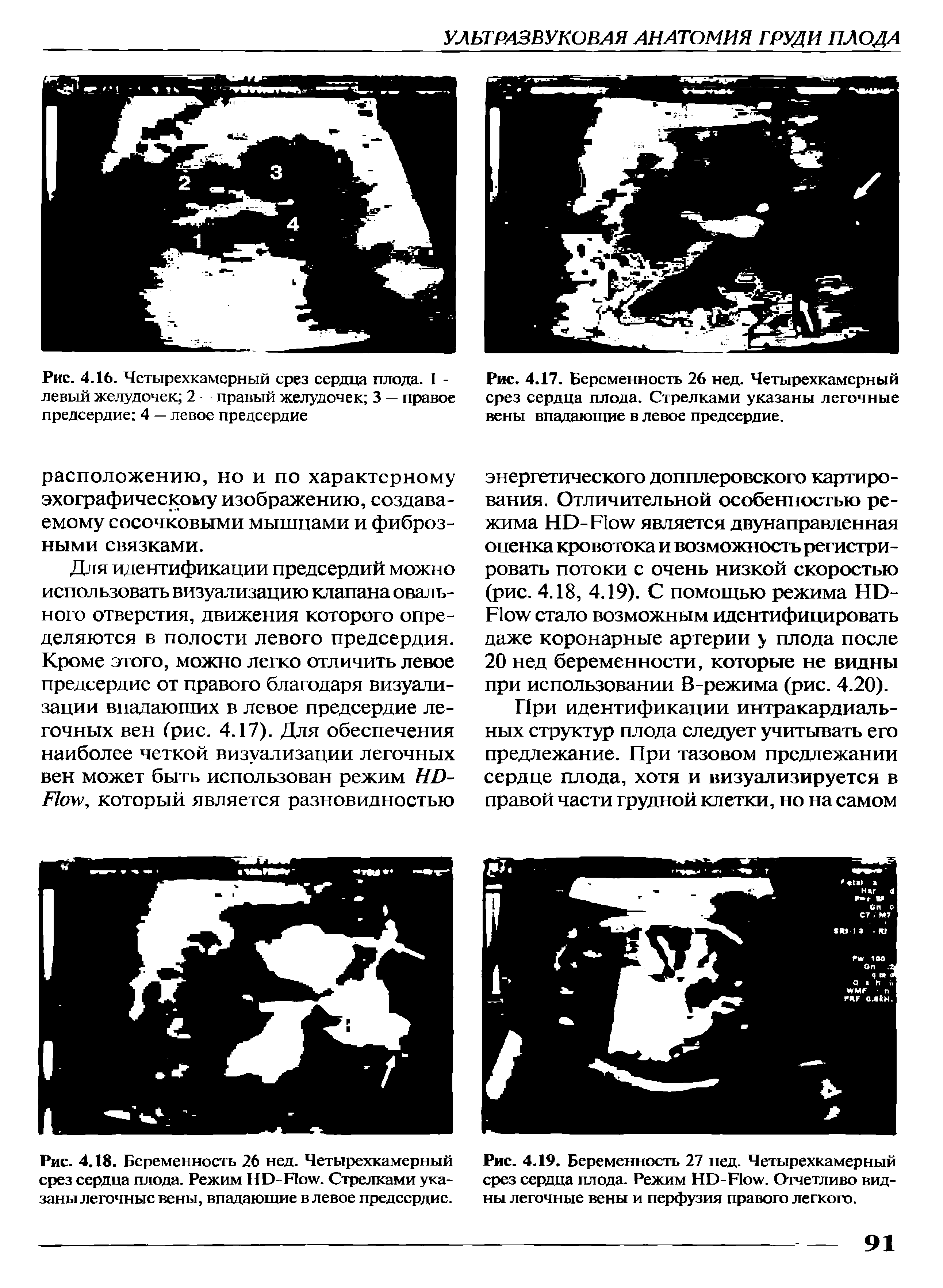 Рис. 4.17. Беременность 26 нед. Четырехкамерный срез сердца плода. Стрелками указаны легочные вены впадающие в левое предсердие.