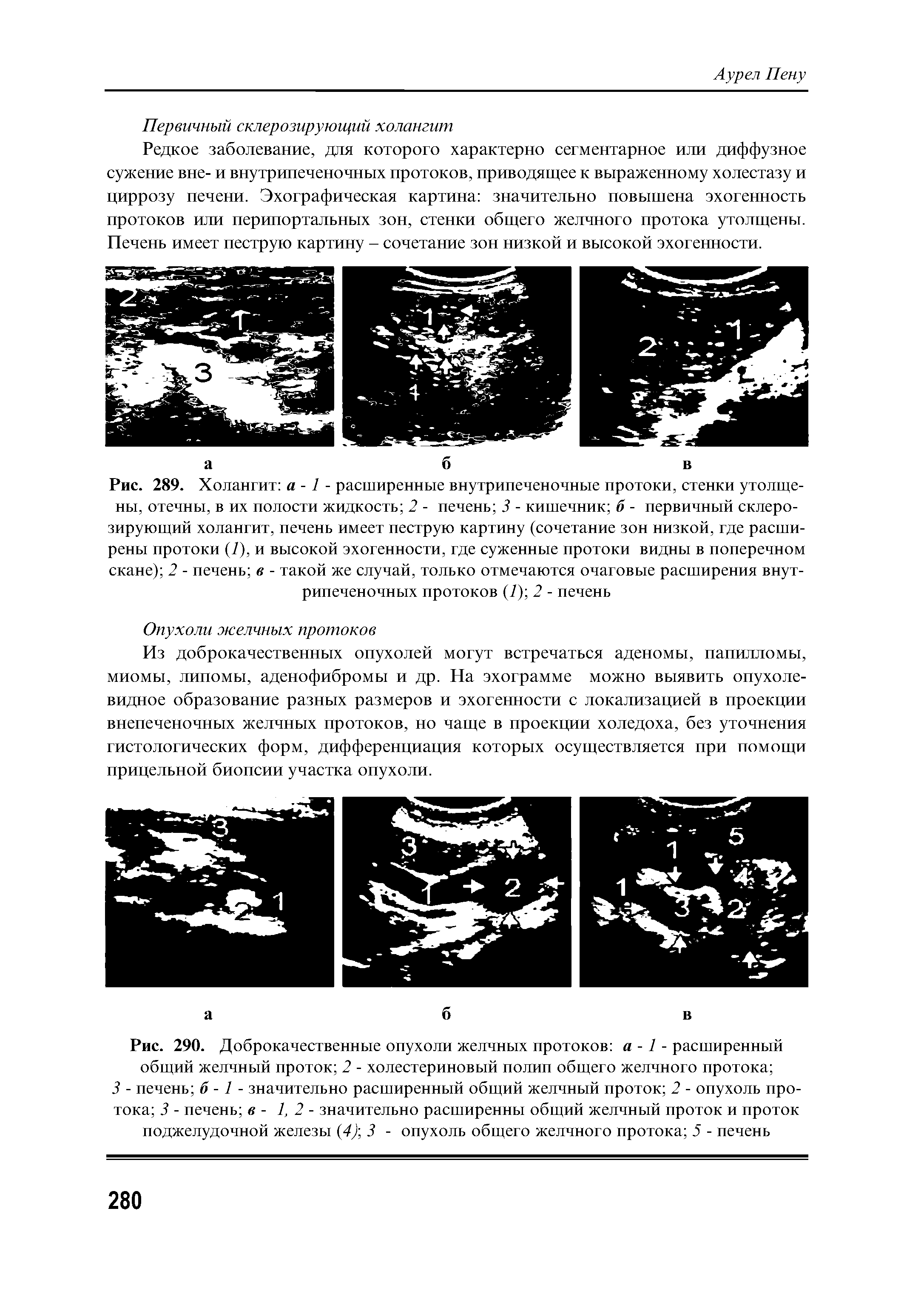 Рис. 290. Доброкачественные опухоли желчных протоков а - 7 - расширенный общий желчный проток 2 - холестериновый полип общего желчного протока ...
