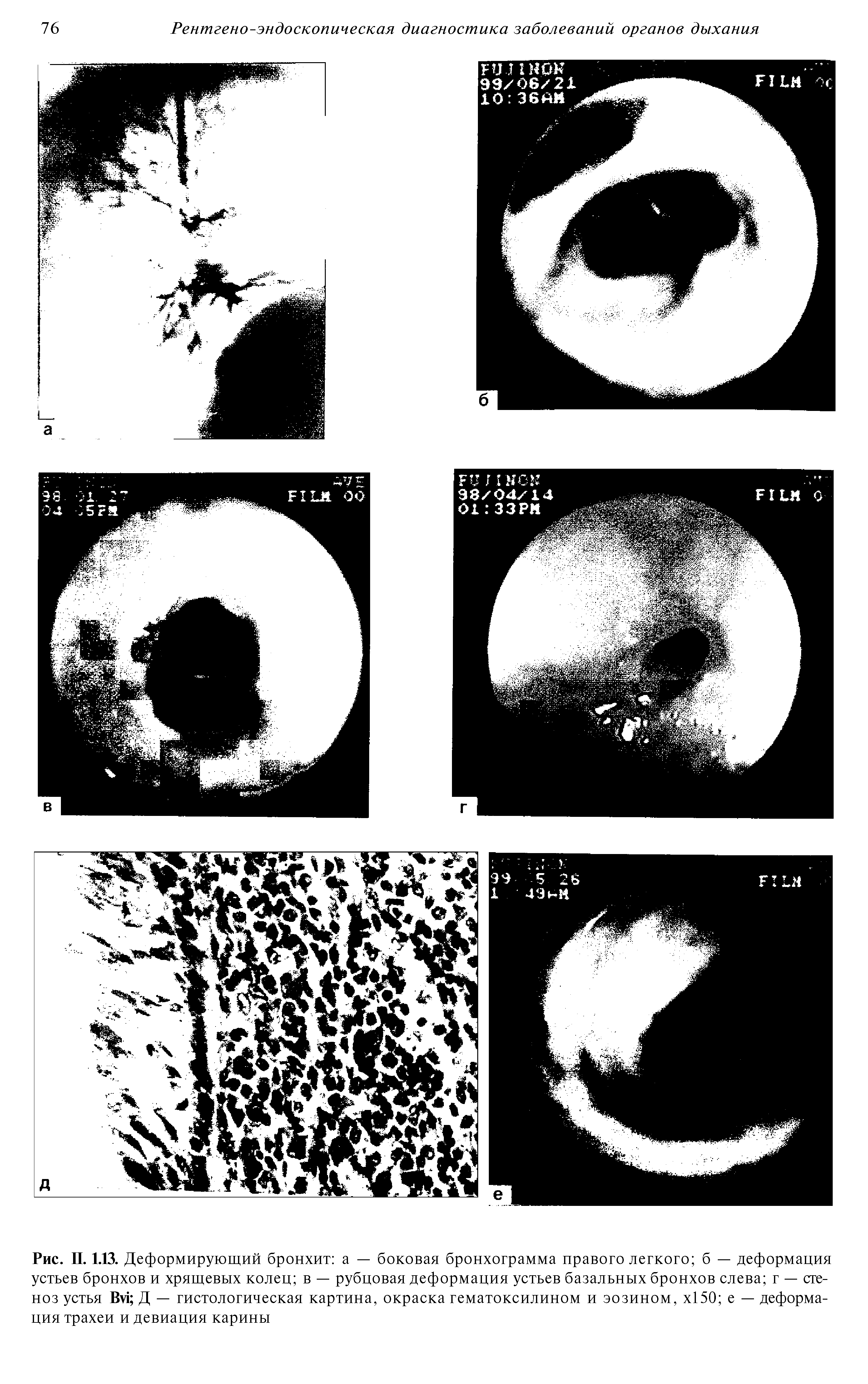 Рис. П. 1.13. Деформирующий бронхит а — боковая бронхограмма правого легкого б — деформация устьев бронхов и хрящевых колец в — рубцовая деформация устьев базальных бронхов слева г — стеноз устья Ви Д — гистологическая картина, окраска гематоксилином и эозином, х150 е — деформация трахеи и девиация карины...