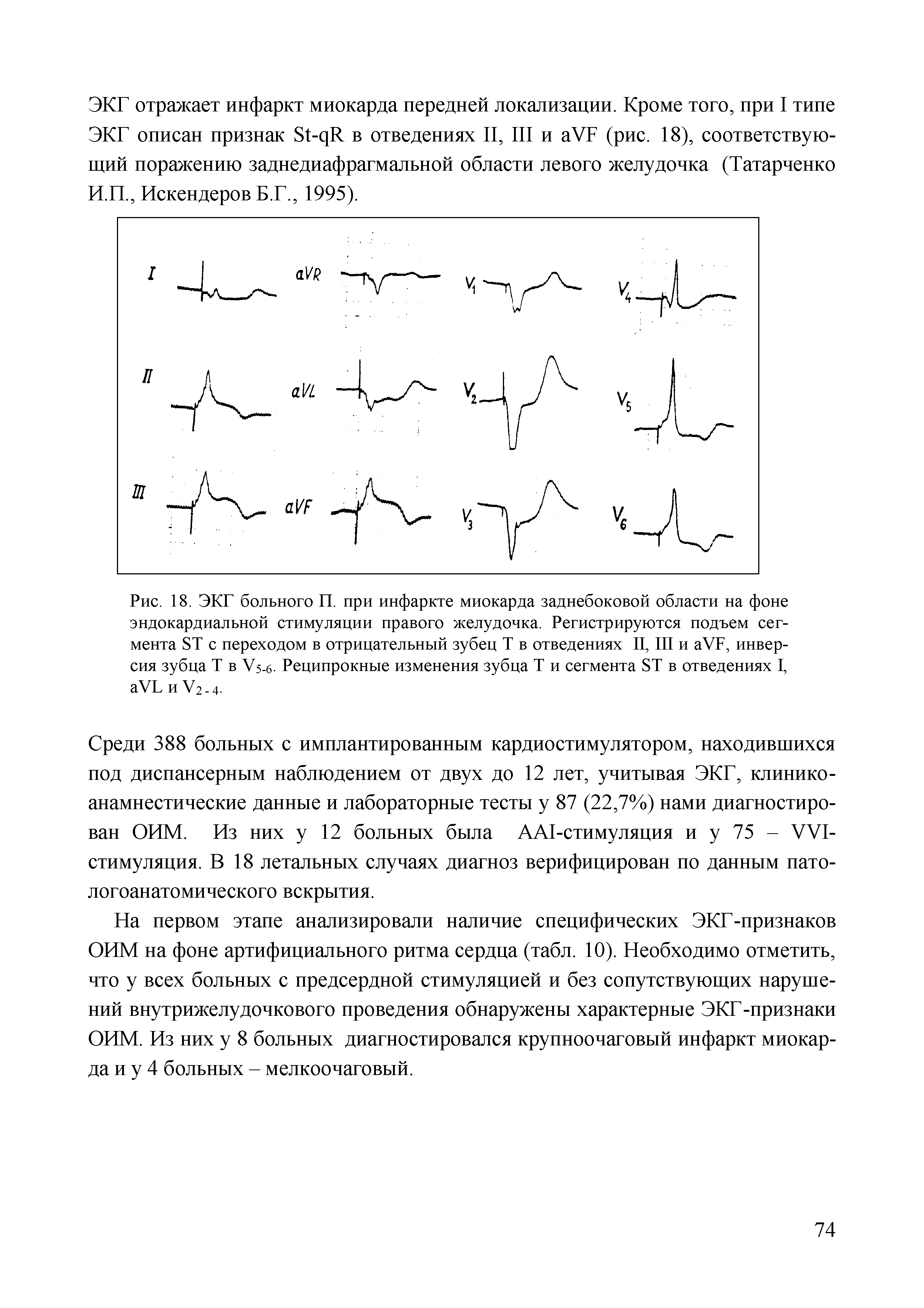 Рис. 18. ЭКГ больного П. при инфаркте миокарда заднебоковой области на фоне эндокардиальной стимуляции правого желудочка. Регистрируются подъем сегмента 8Т с переходом в отрицательный зубец Т в отведениях II, III и аУГ, инверсия зубца Т в У5-6. Реципрокные изменения зубца Т и сегмента 8Т в отведениях I, аУЬ и У2.4.