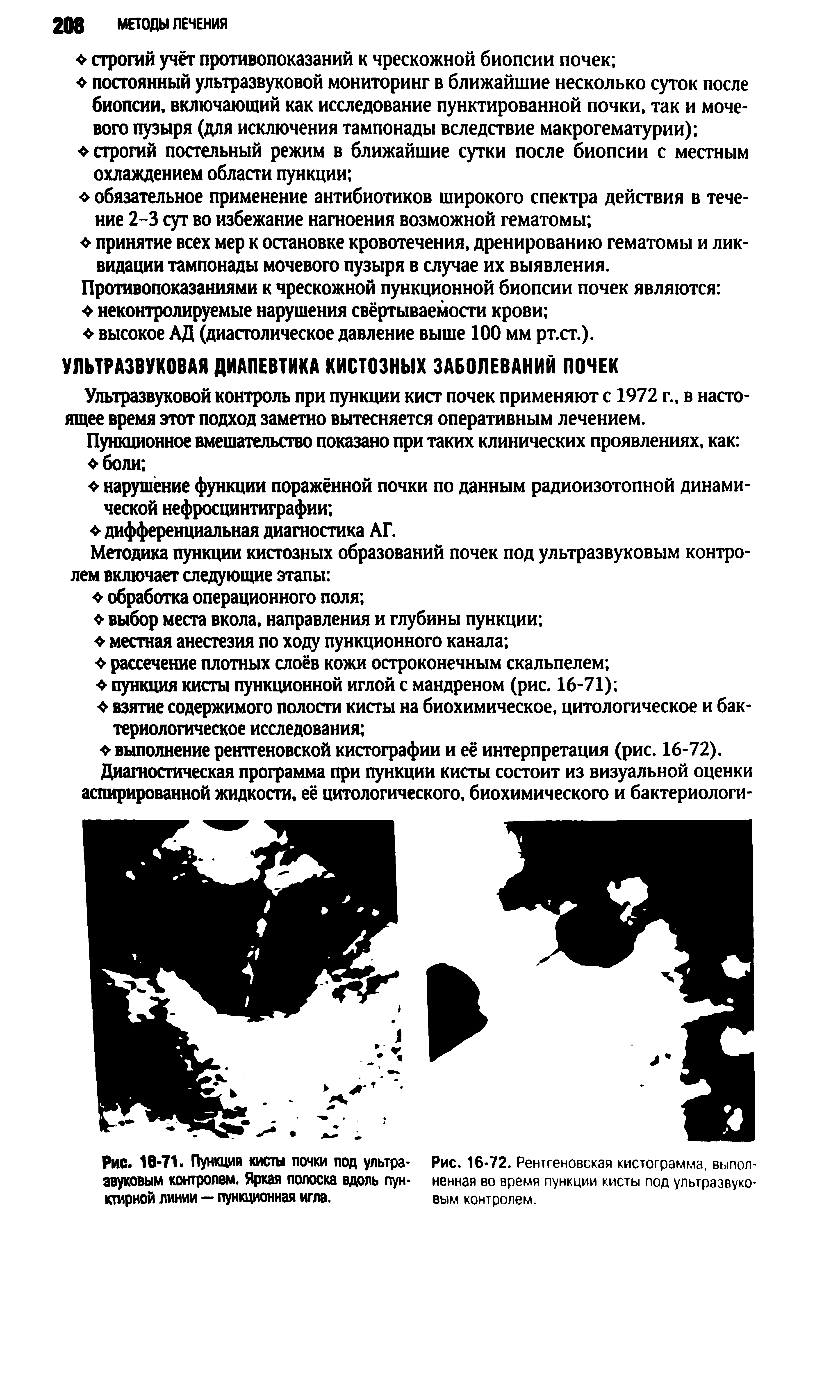 Рис. 16-71. Пункция кисты почки под ультразвуковым контролем. Яркая полоска вдоль пунктирной линии — пункционная игла.