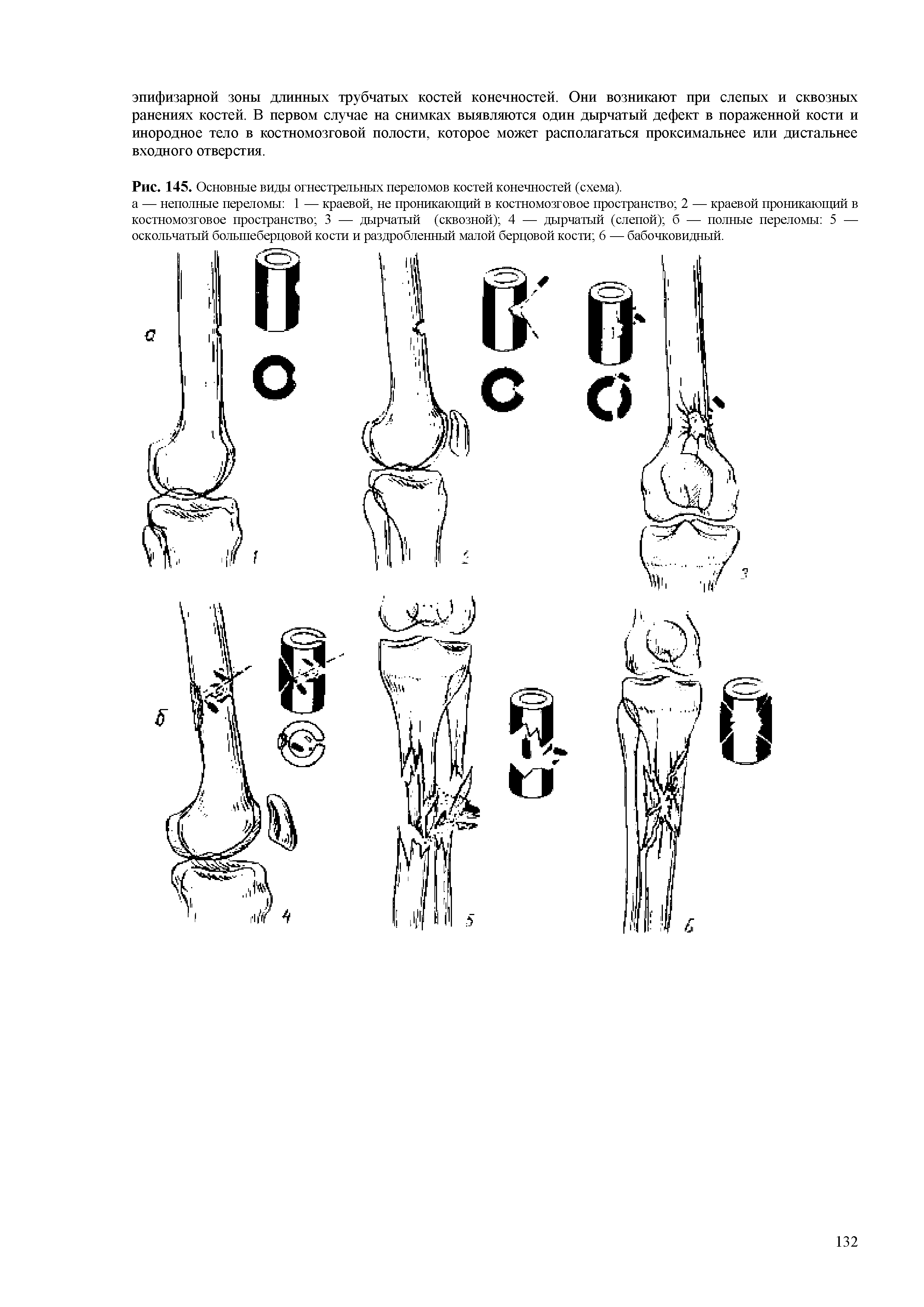 Рис. 145. Основные виды огнестрельных переломов костей конечностей (схема).