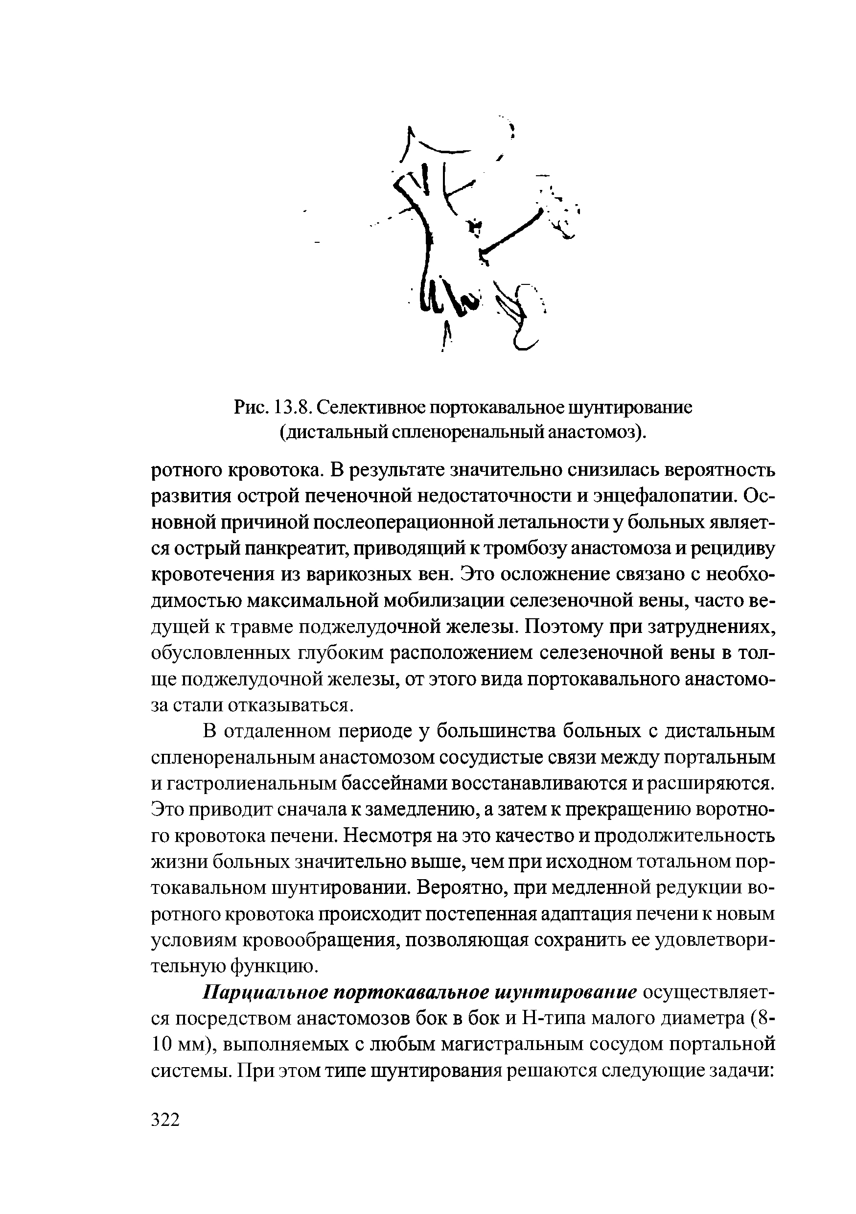 Рис. 13.8. Селективное портокавальное шунтирование (дистальный спленоренальный анастомоз).