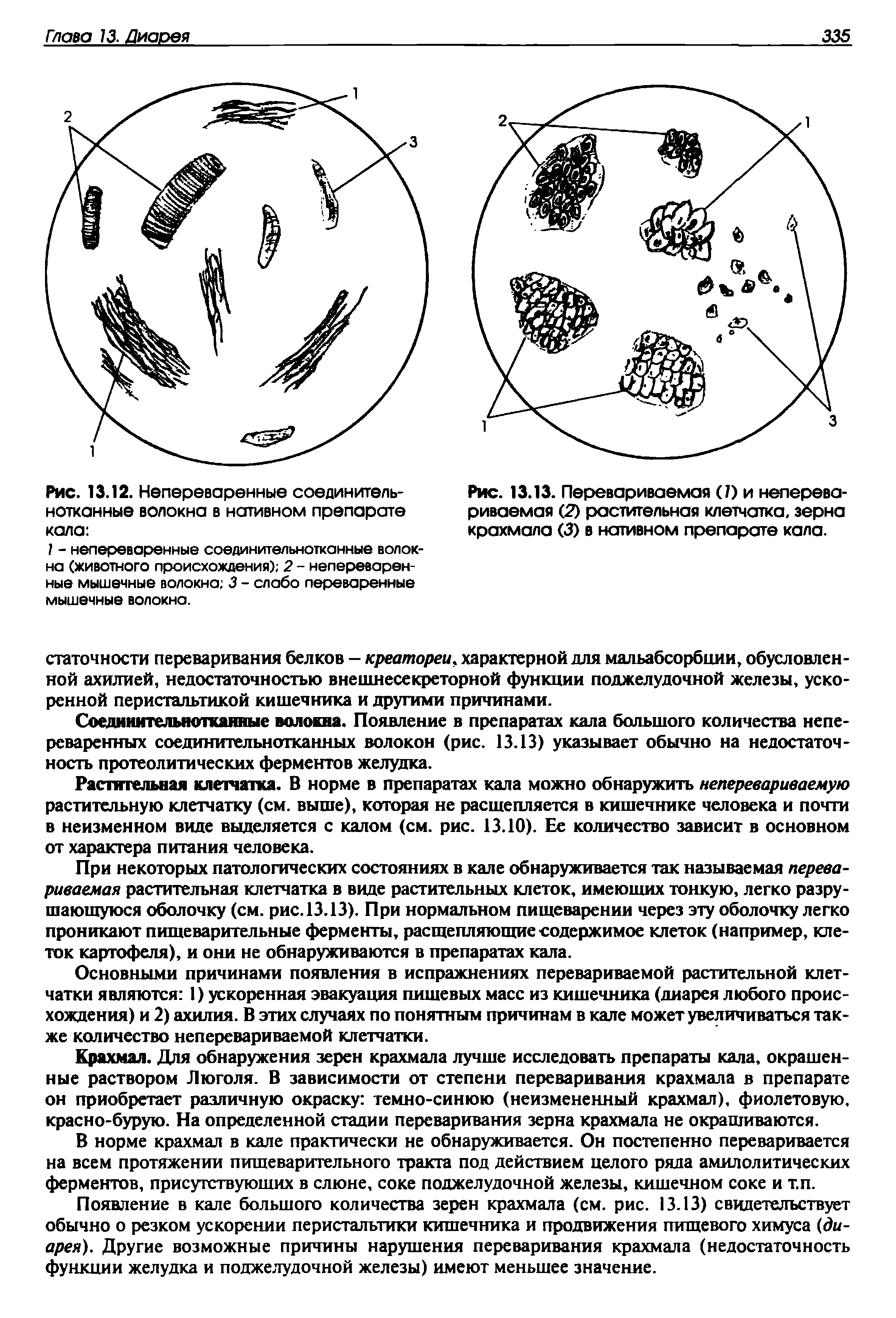 Рис. 13.13. Перевариваемая ( ) и неперева-риваемая (2) растительная клетчатка, зерна крахмала (3) в нативном препарате кала.