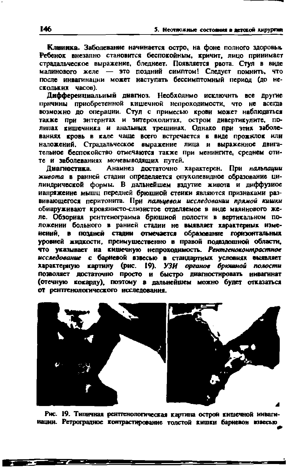 Рис. 19. Типичная рентгенологическая картина острой кишечной инвагинации. Ретроградное контрастирование толстой кишки бариевом взвесью...