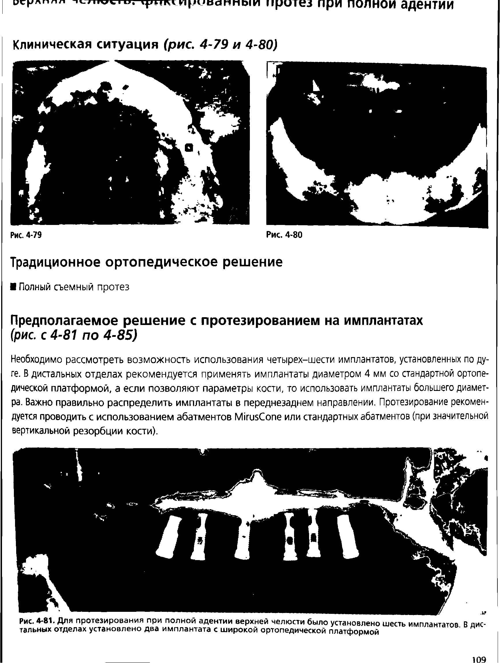 Рис. 4-81. Для протезирования при полной адентии верхней челюсти было установлено шесть имплантатов В дистальных отделах установлено два имплантата с широкой ортопедической платформой...