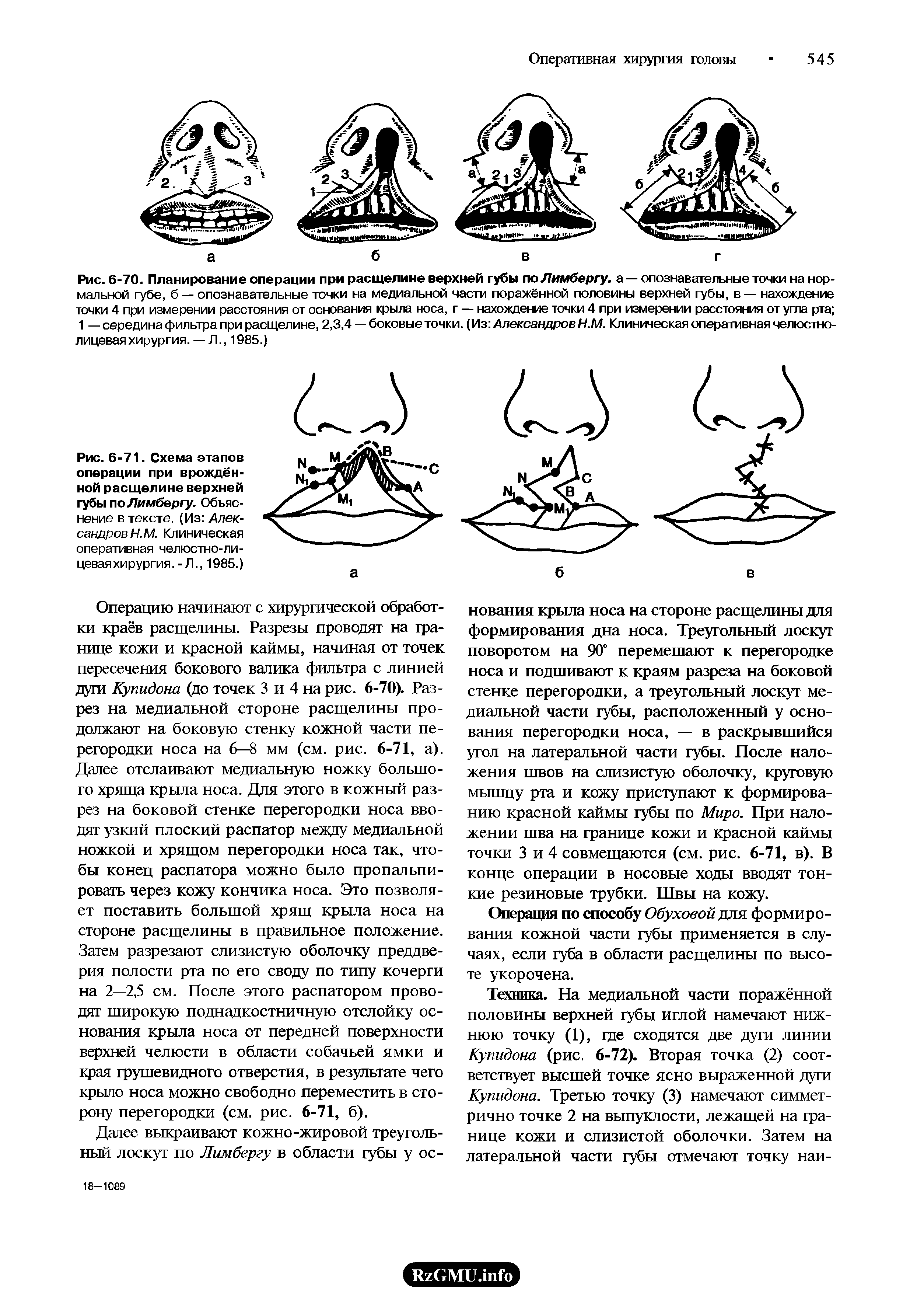 Рис. 6-71. Схема этапов операции при врождённой расщелине верхней губы по Лимбергу. Объяснение в тексте. (Из Александров Н.М. Клиническая оперативная челюстно-лицевая хирургия. -Л., 1985.)...