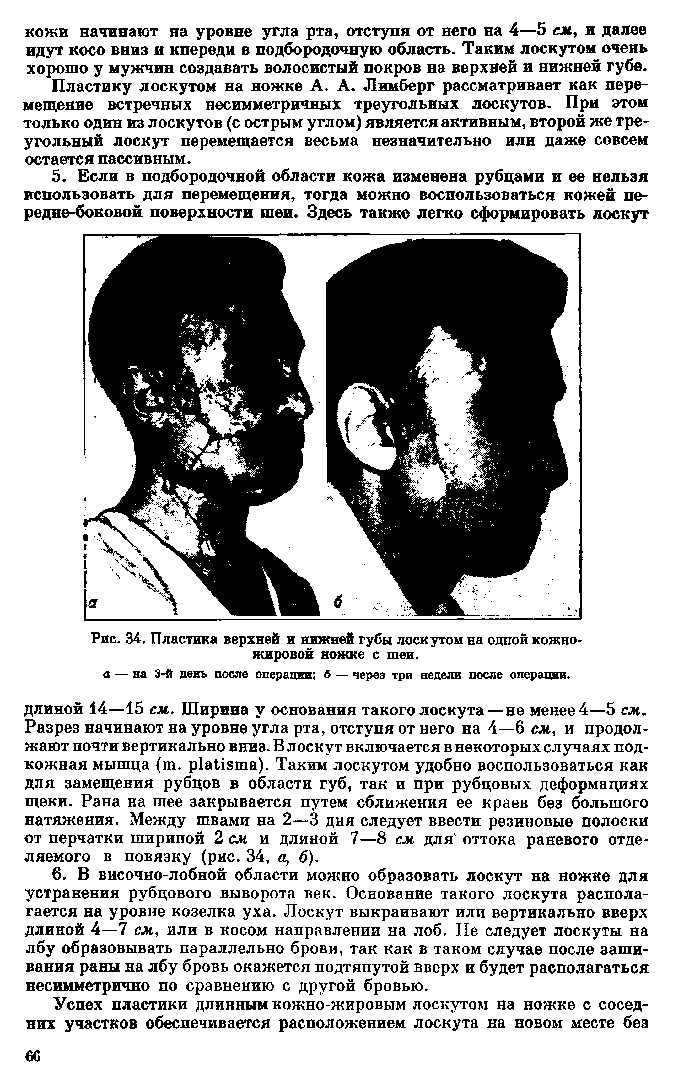 Рис. 34. Пластика верхней и нижней губы лоскутом на одной кожножировой ножке с шеи.