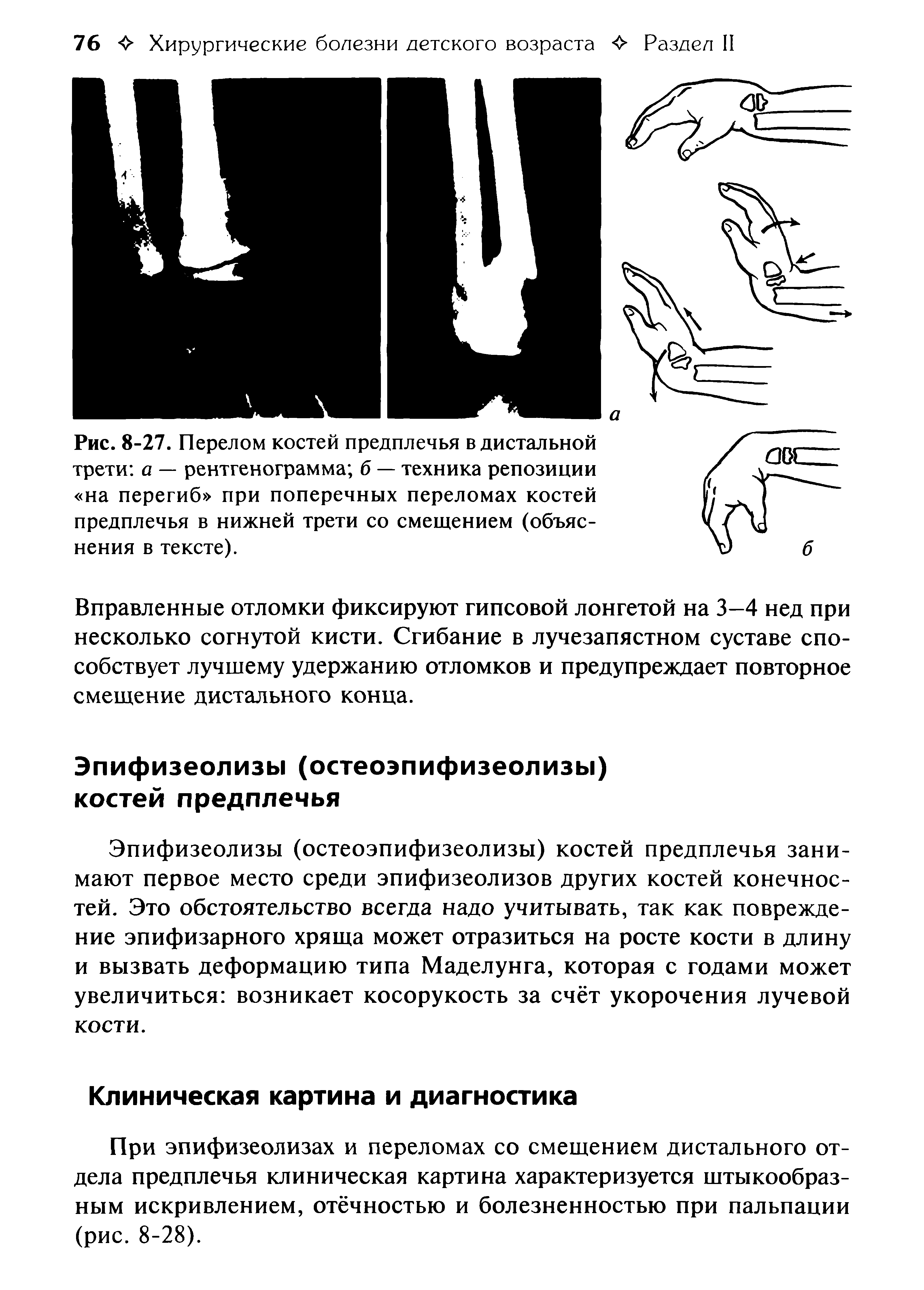 Рис. 8-27. Перелом костей предплечья в дистальной трети а — рентгенограмма б — техника репозиции на перегиб при поперечных переломах костей предплечья в нижней трети со смещением (объяснения в тексте).