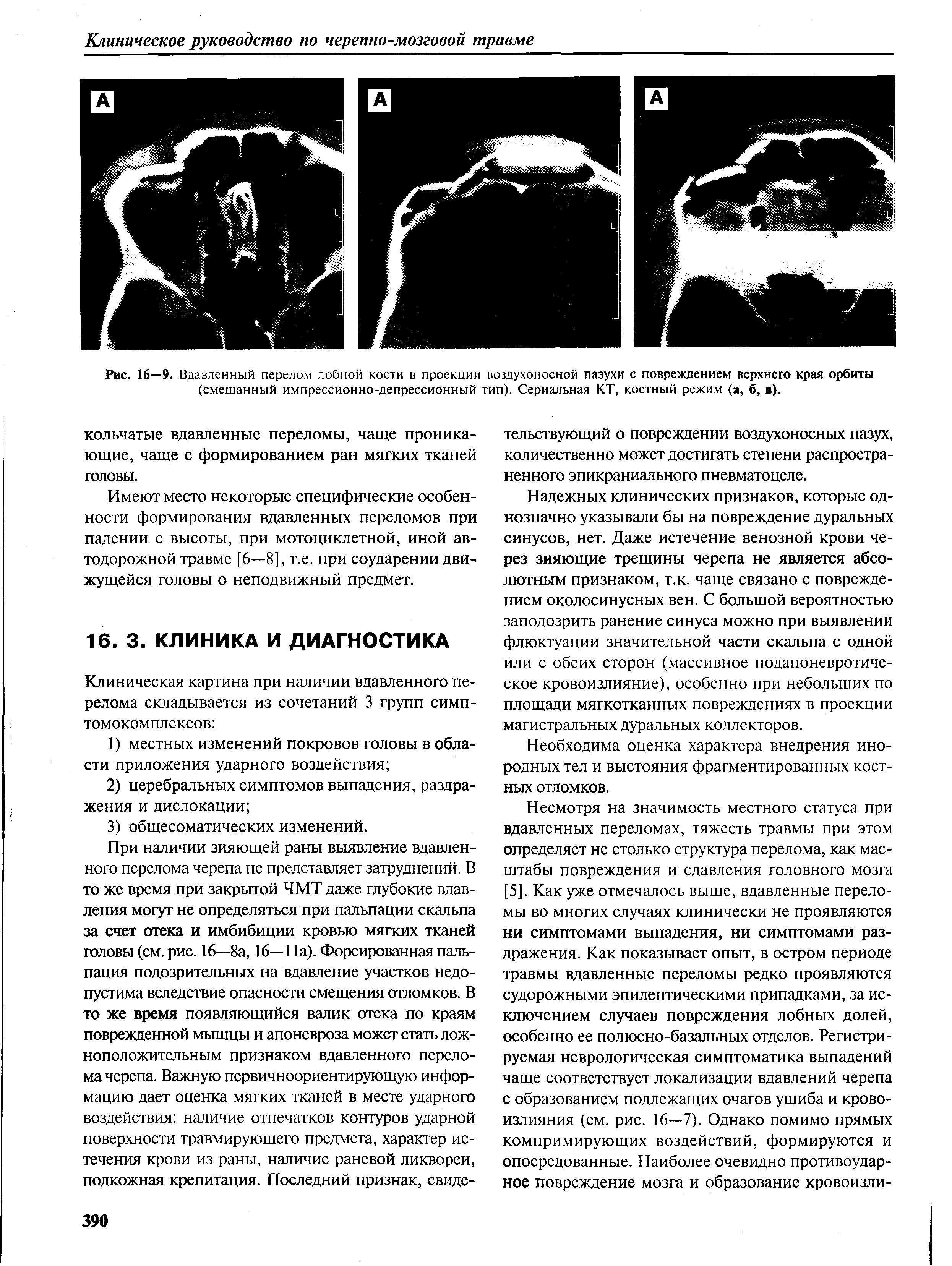 Рис. 16—9. Вдавленный перелом лобной кости в проекции воздухоносной пазухи с повреждением верхнего края орбиты (смешанный импрессионно-депрессионный тип). Сериальная КТ, костный режим (а, б, в).