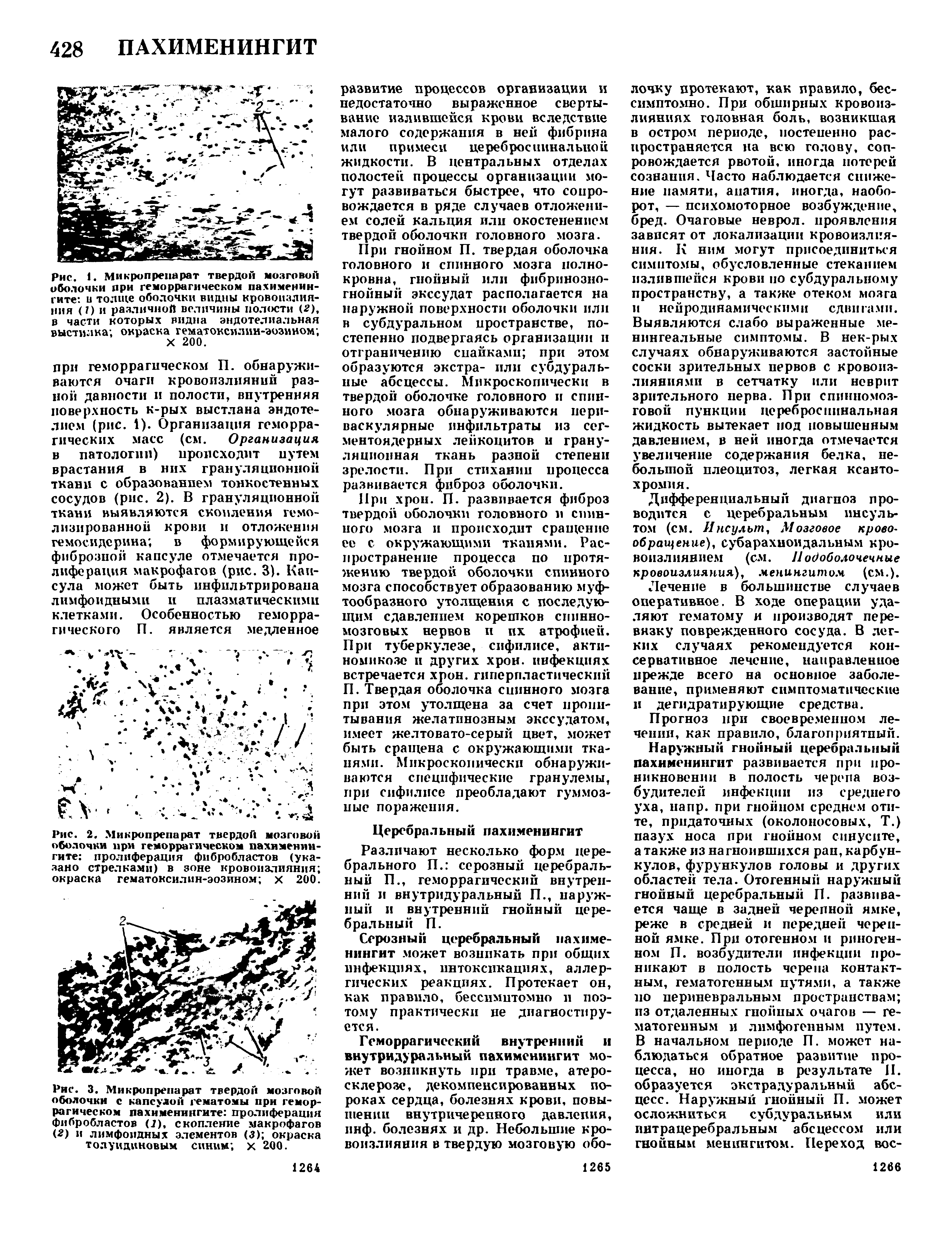 Рис. 2. Микропрепарат твердой мозговой оболочки при геморрагическом пахименингите пролиферация фибробластов (указано стрелками) в зоне кровоизлияния окраска гематоксилин-эозином х 200.