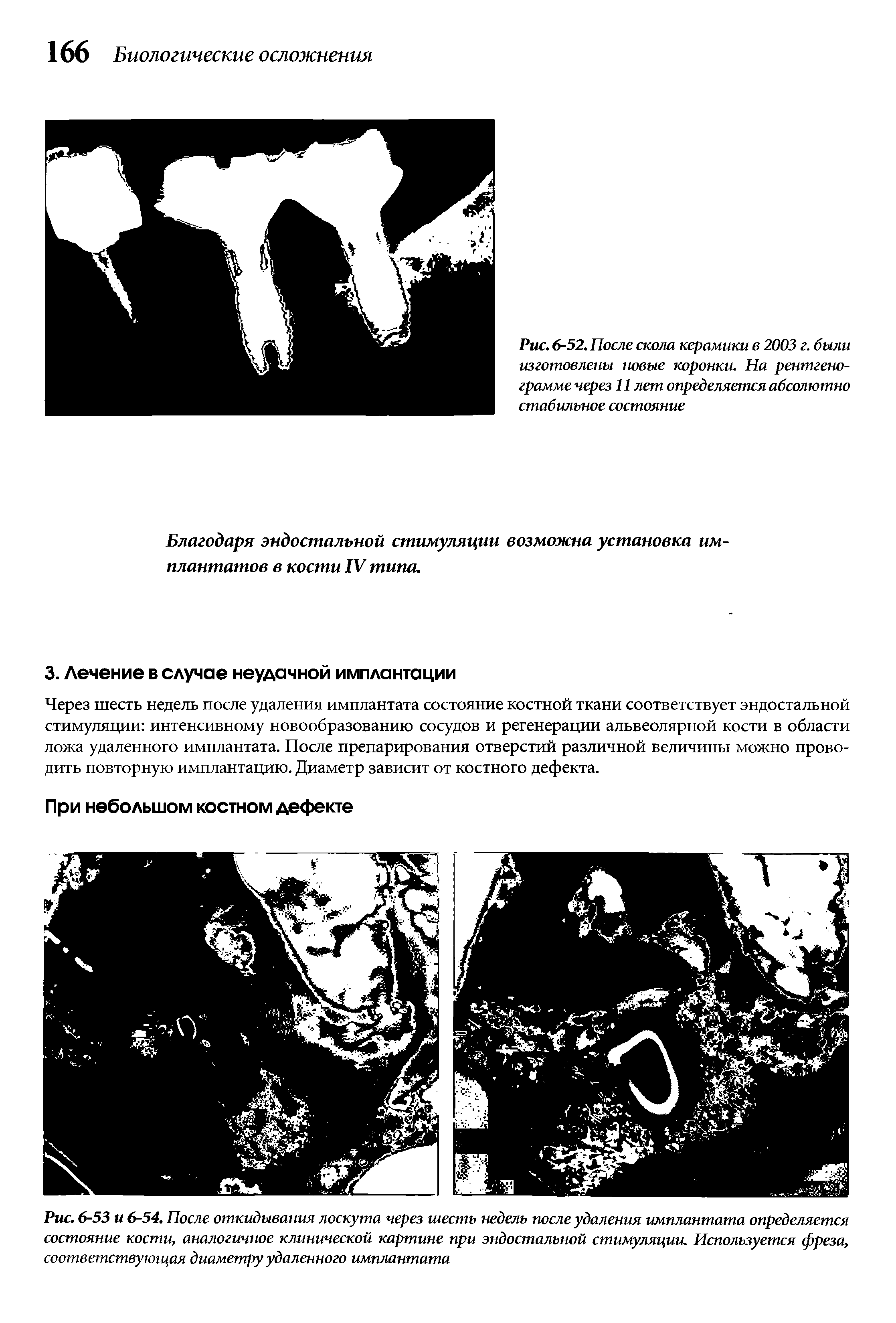 Рис. 6-52. После скола керамики в 2003 г. были изготовлены новые коронки. На рентгенограмме через 11 лет определяется абсолютно стабильное состояние...