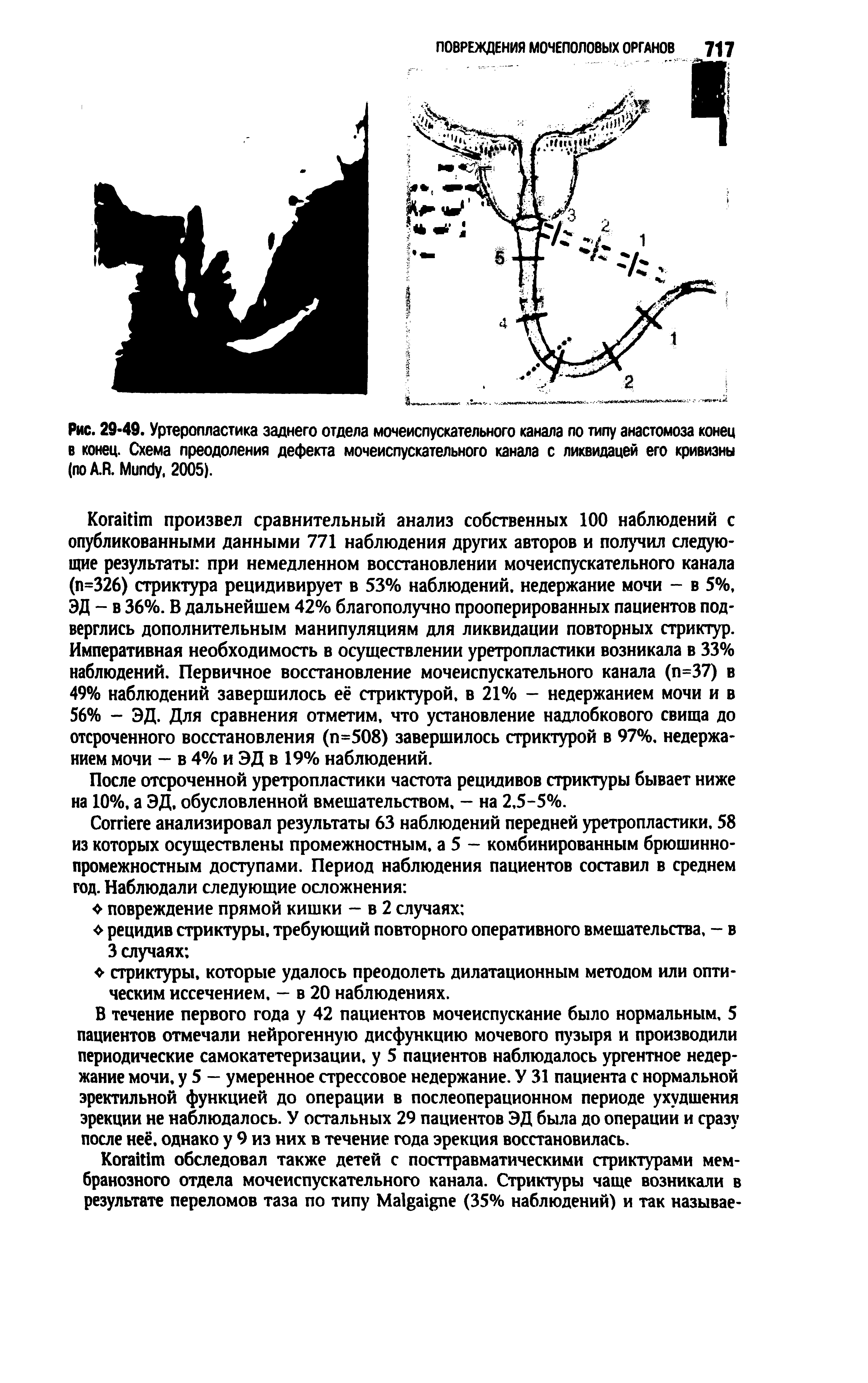 Рис. 29-49. Уртеропластика заднего отдела мочеиспускательного канала по типу анастомоза конец в конец. Схема преодоления дефекта мочеиспускательного канала с ликвидацей его кривизны ( A.R, M , 2005).