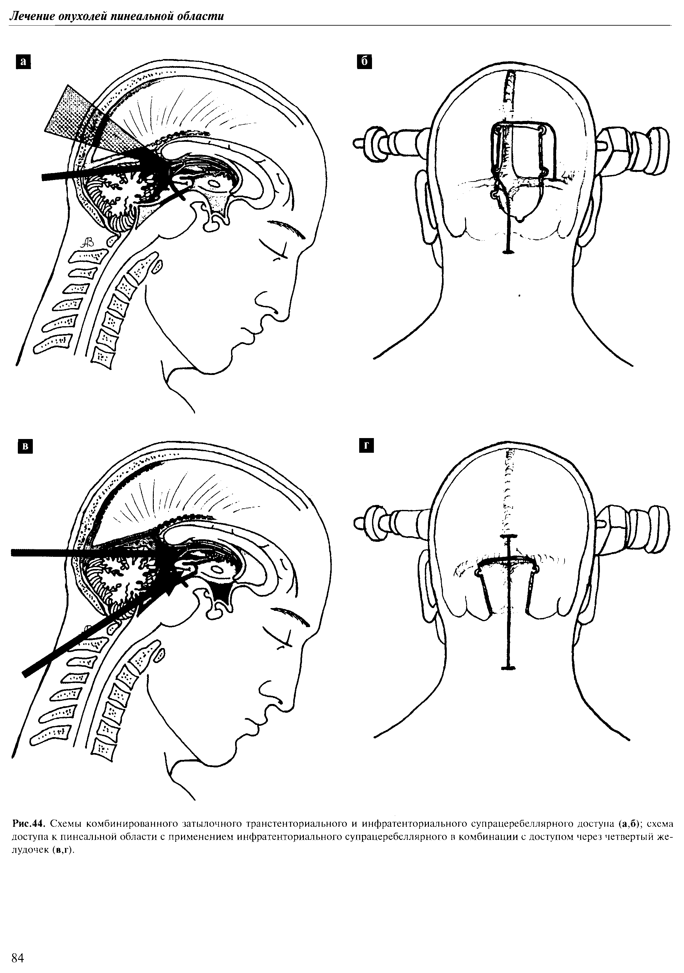 Рис.44. Схемы комбинированного затылочного транстенториального и инфратенториального супрацеребеллярного доступа (а,б) схема доступа к пинеальной области с применением инфратенториального супрацеребеллярного и комбинации с доступом через четвертый желудочек (в,г).