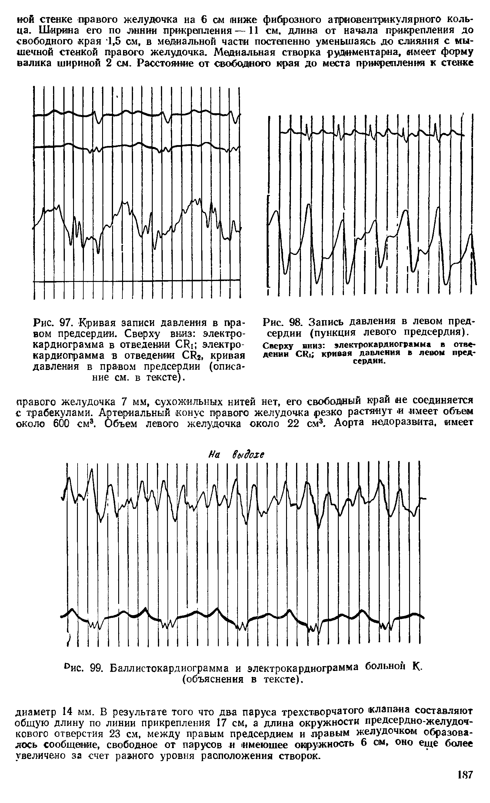 Рис. 98. Запись давления в левом предсердии (пункция левого предсердия).