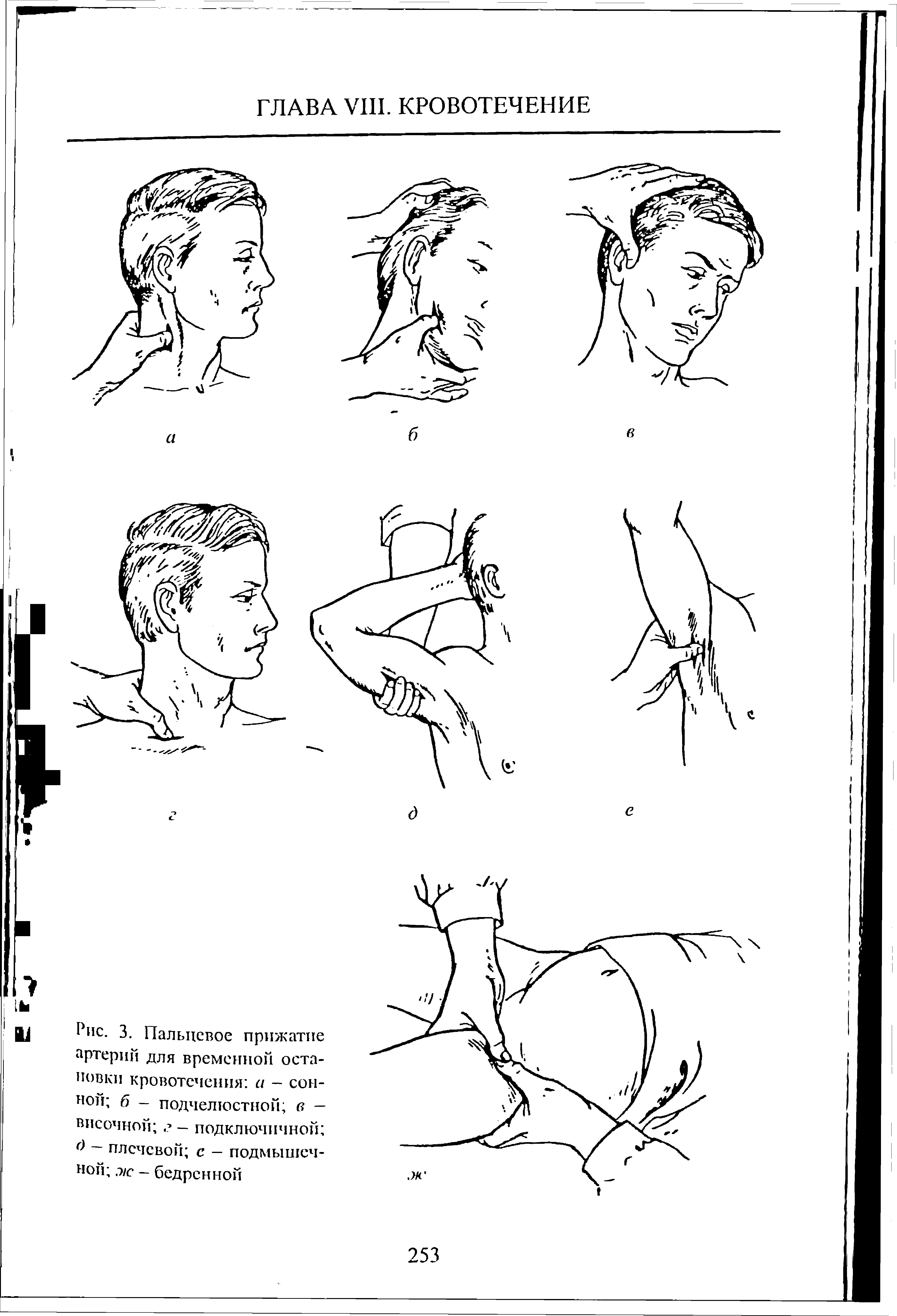 Рис. 3. Пальцевое прижатие артерий для временной остановки кровотечения а — сонной б - подчелюстной в — височной г — подключичной ...